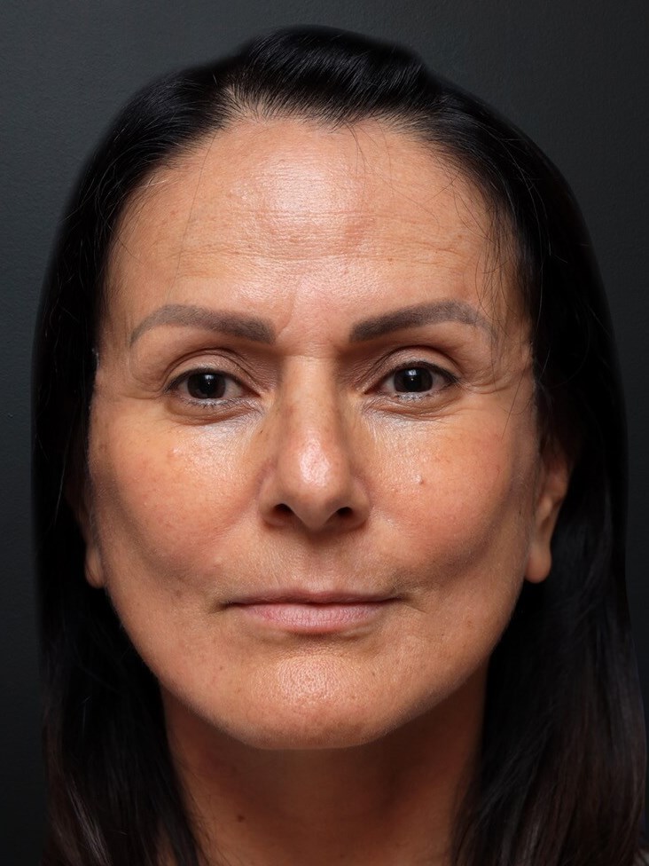 Frontal After