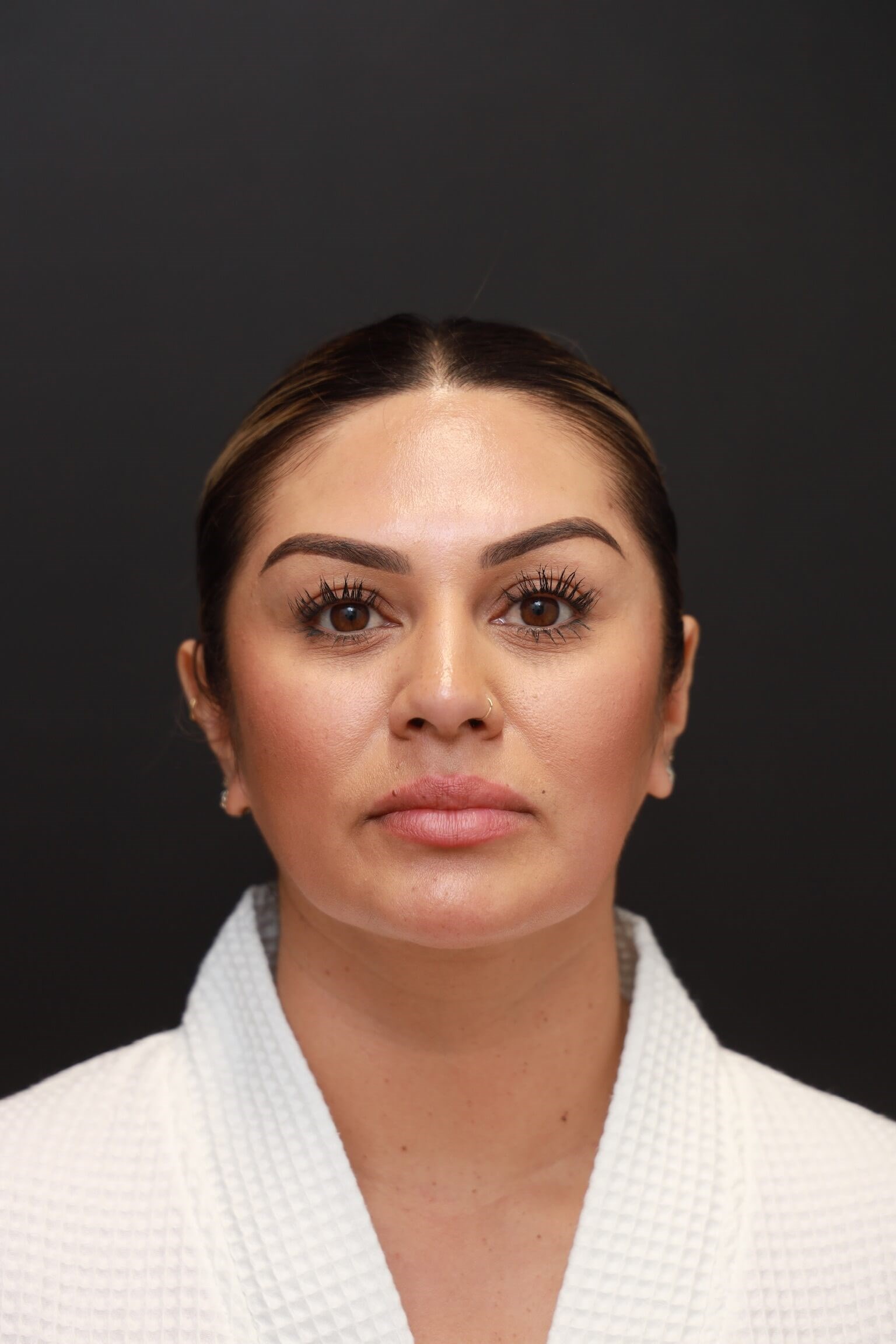 Frontal After