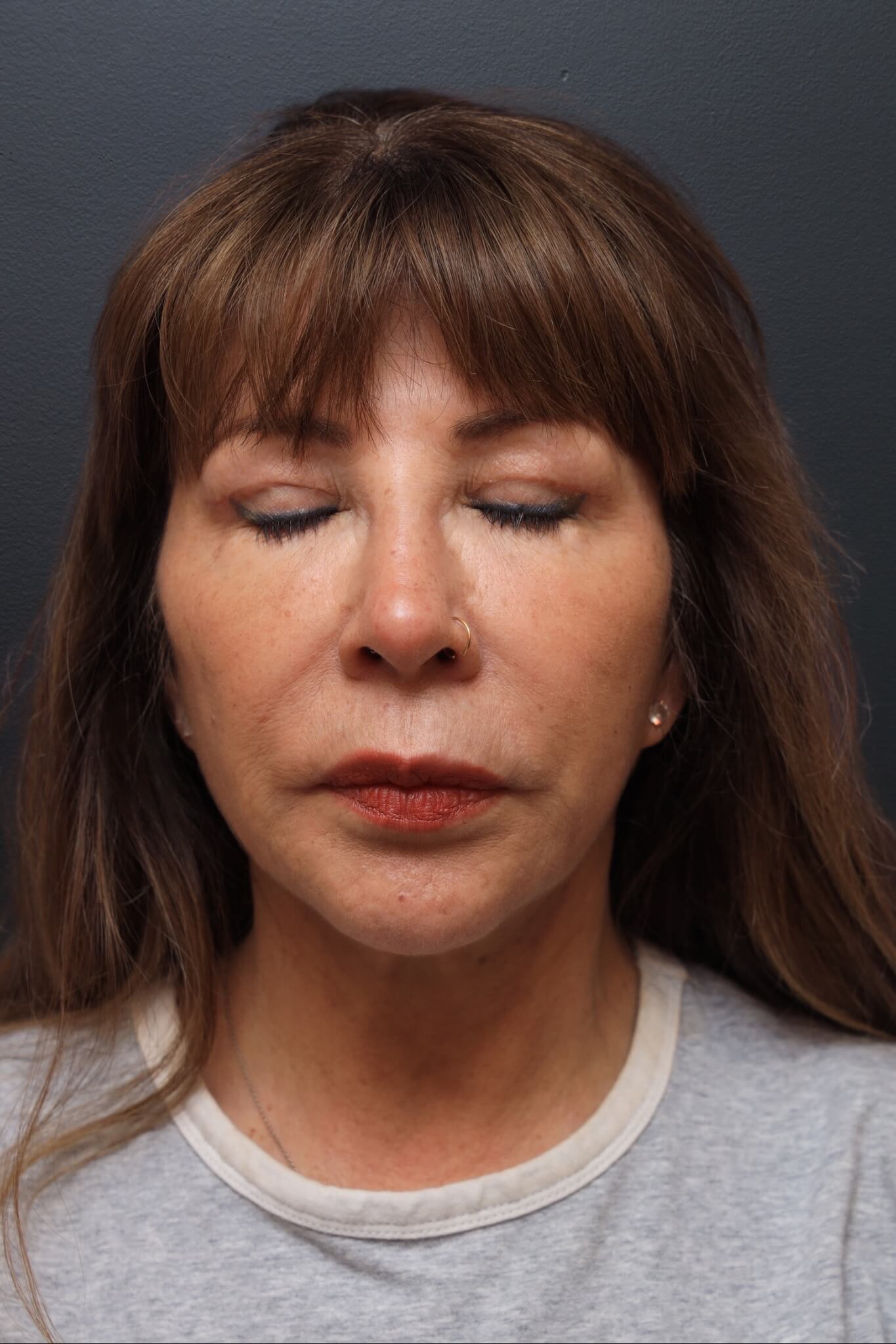 Frontal Eyes Closed After
