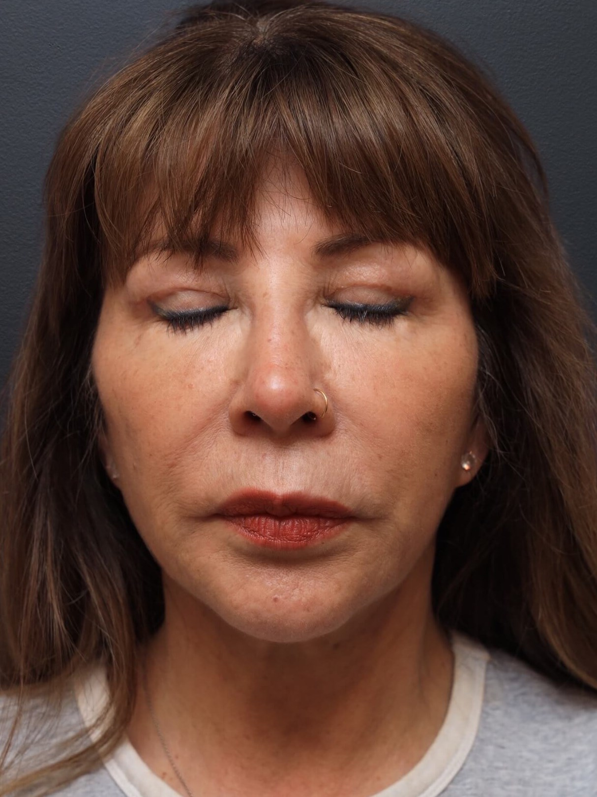 Frontal Eyes Closed After