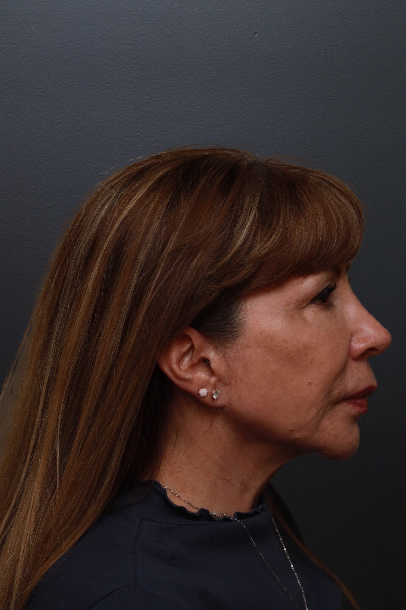 Right Lateral Before