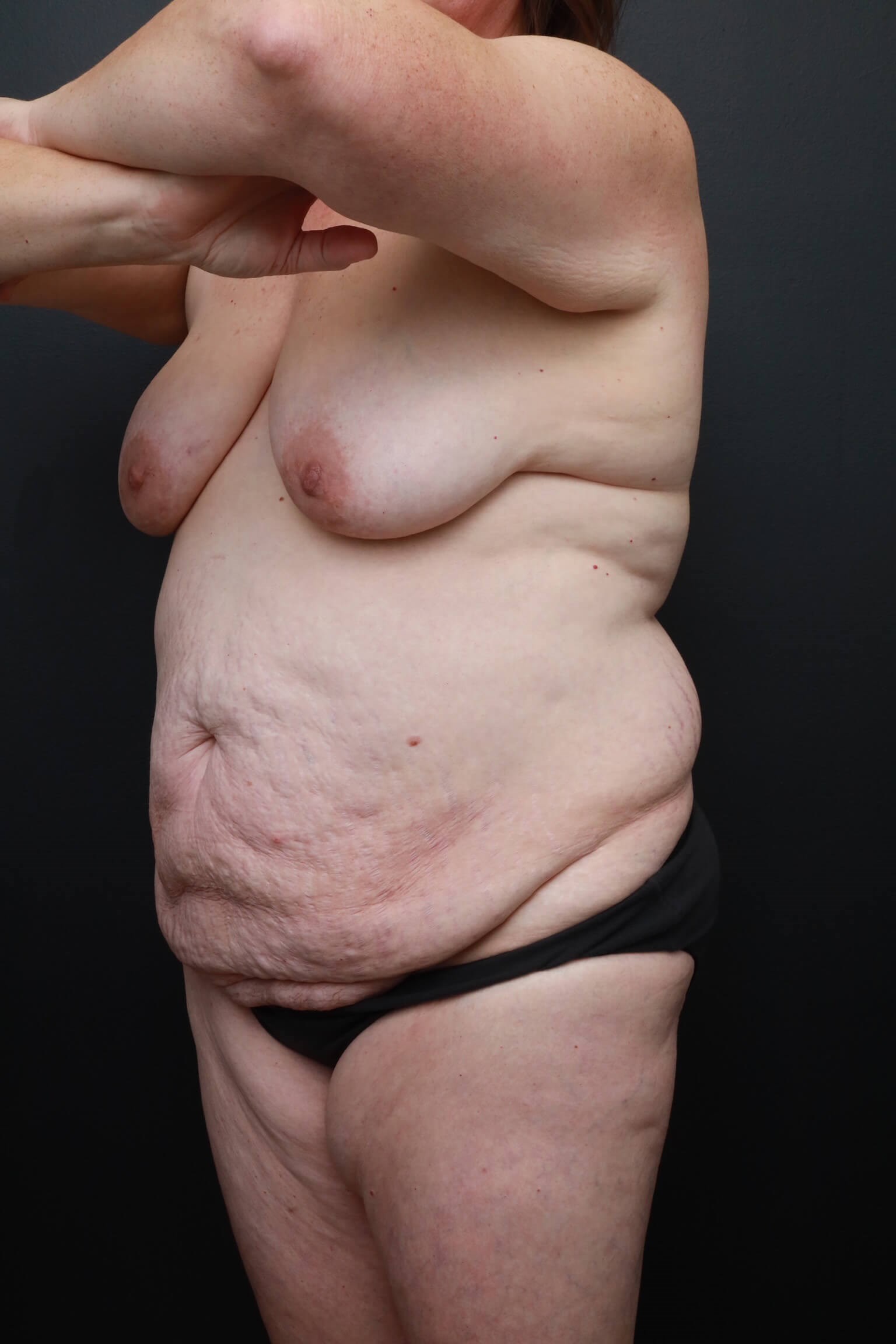 Left Oblique Before