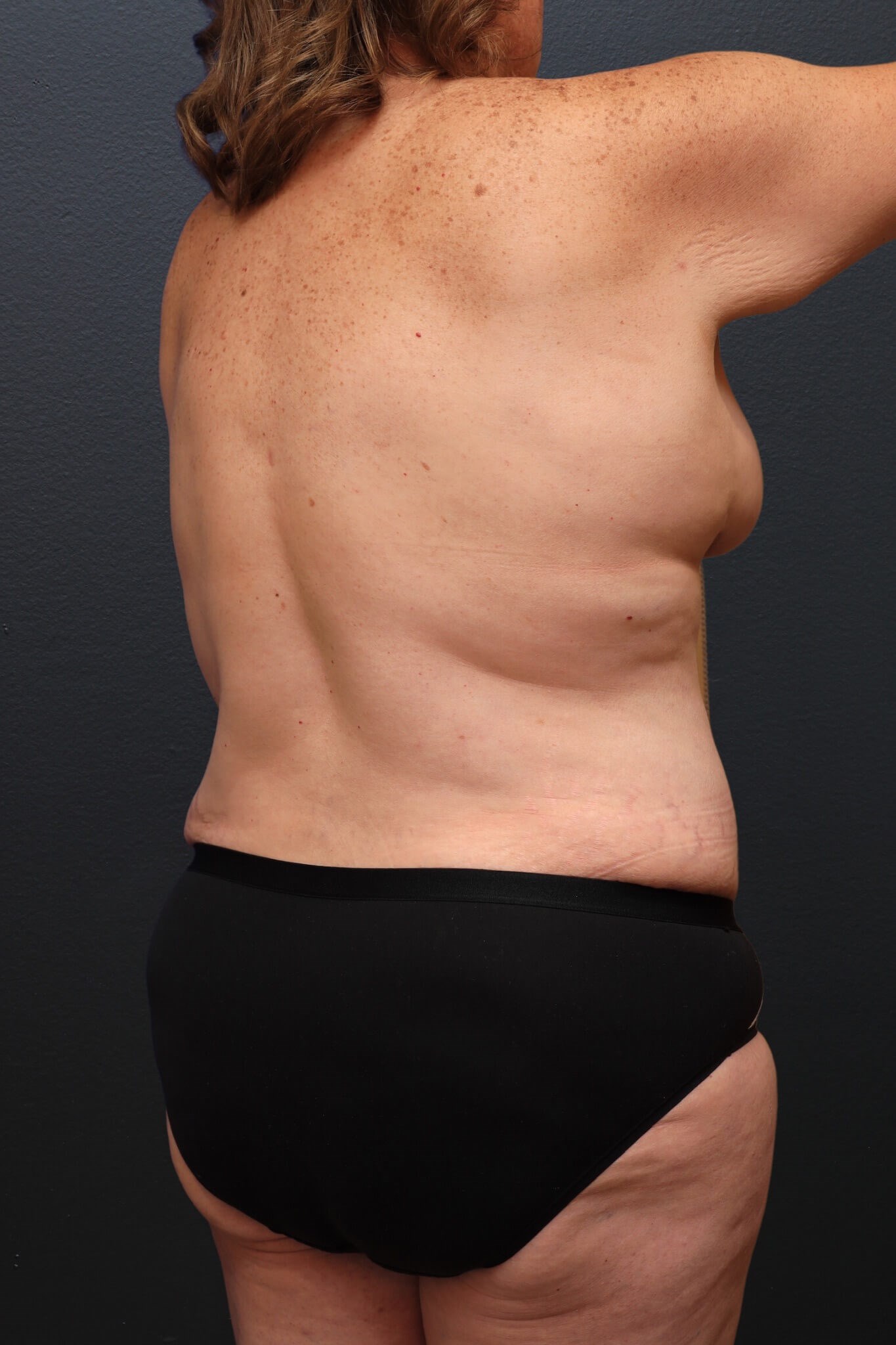 Right Anterior Oblique After