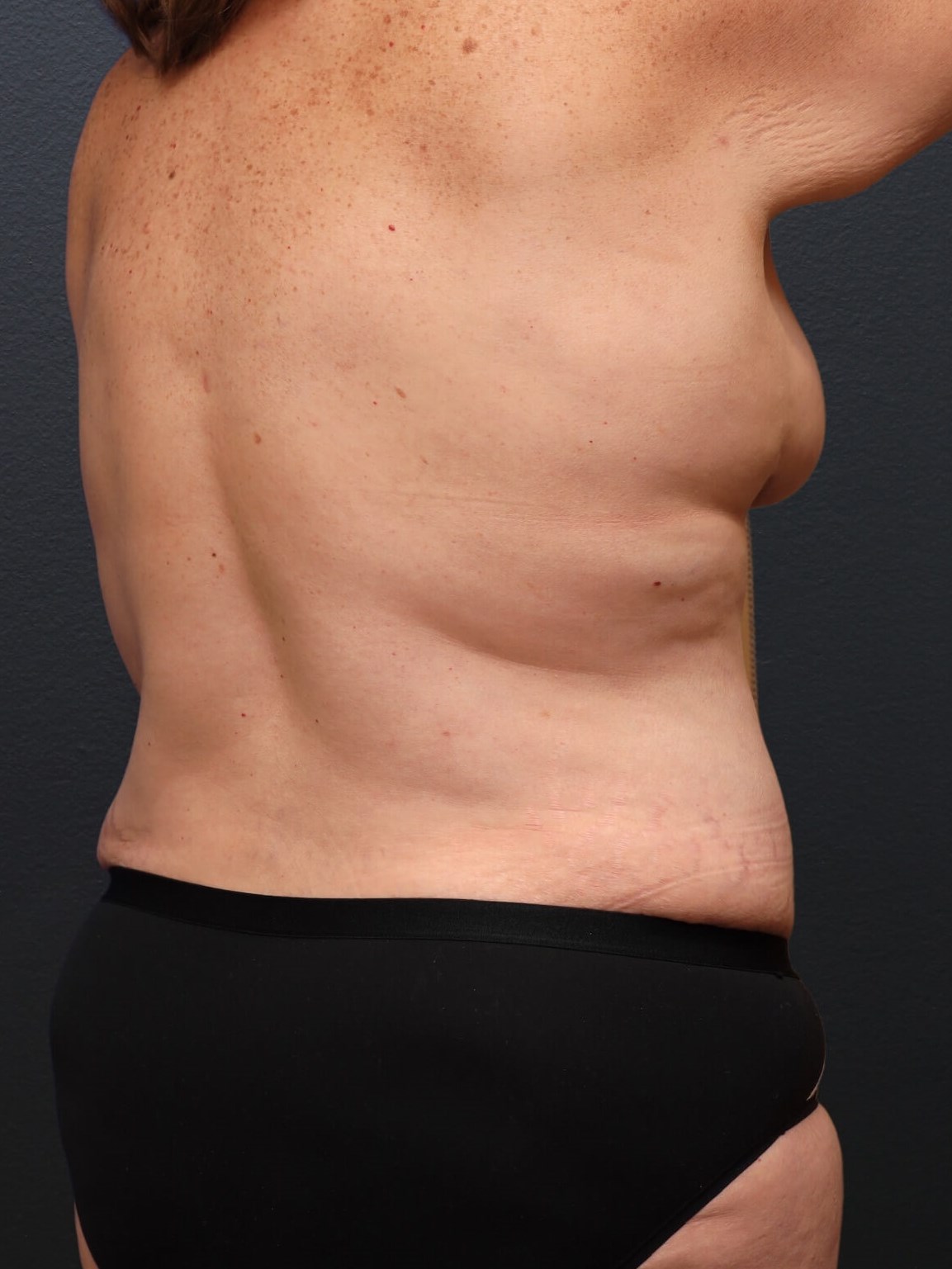 Right Anterior Oblique After