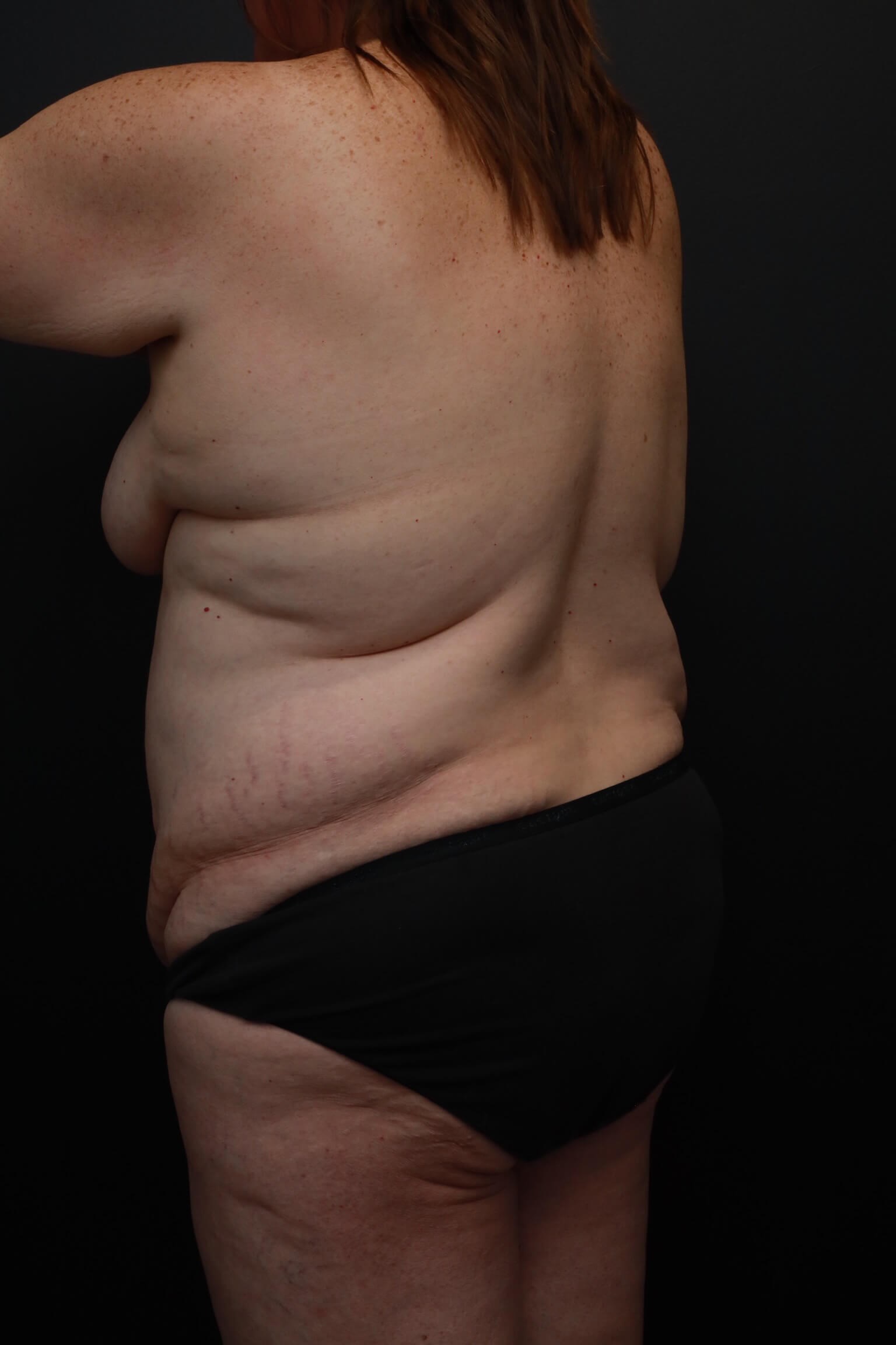 Left Anterior Oblique Before