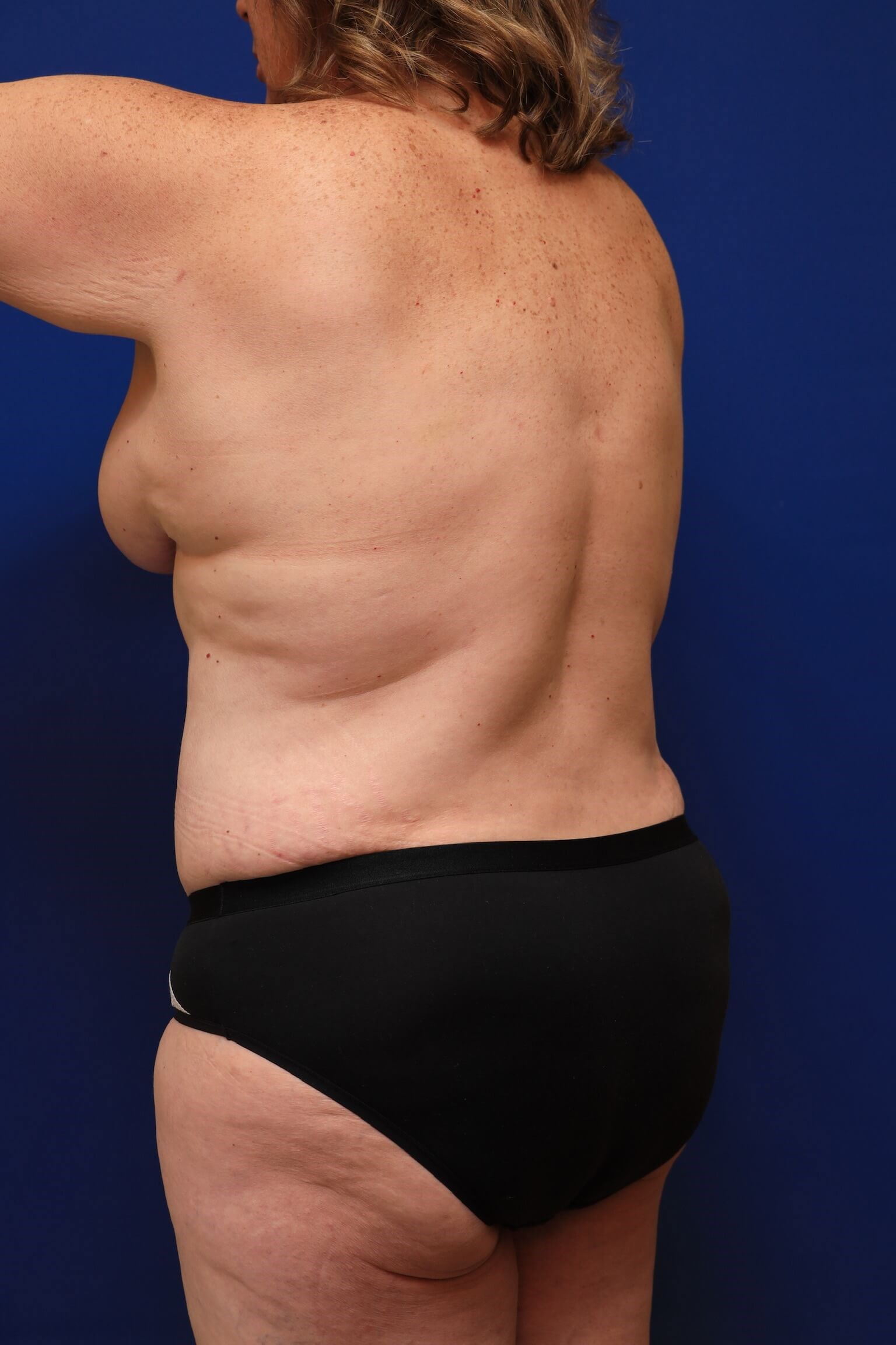 Left Anterior Oblique After