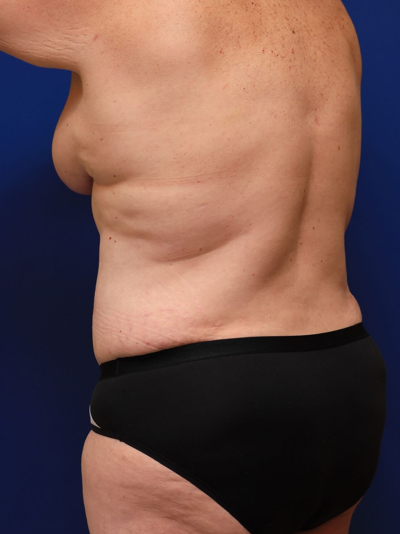 Left Anterior Oblique After