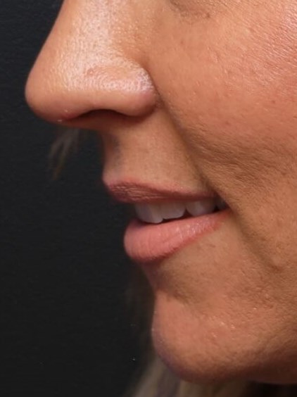 Left Lateral After