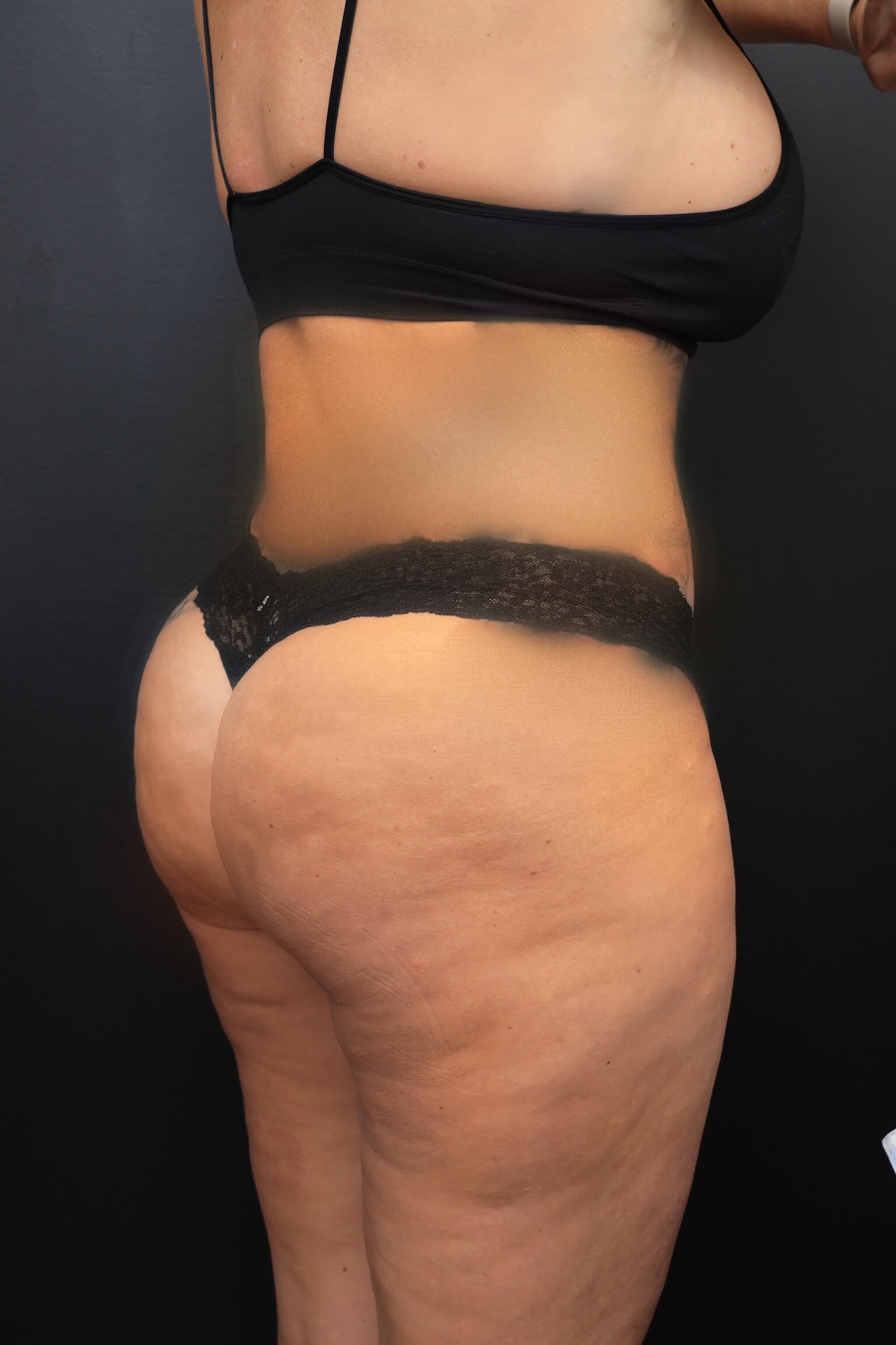 Right Posterior Oblique After