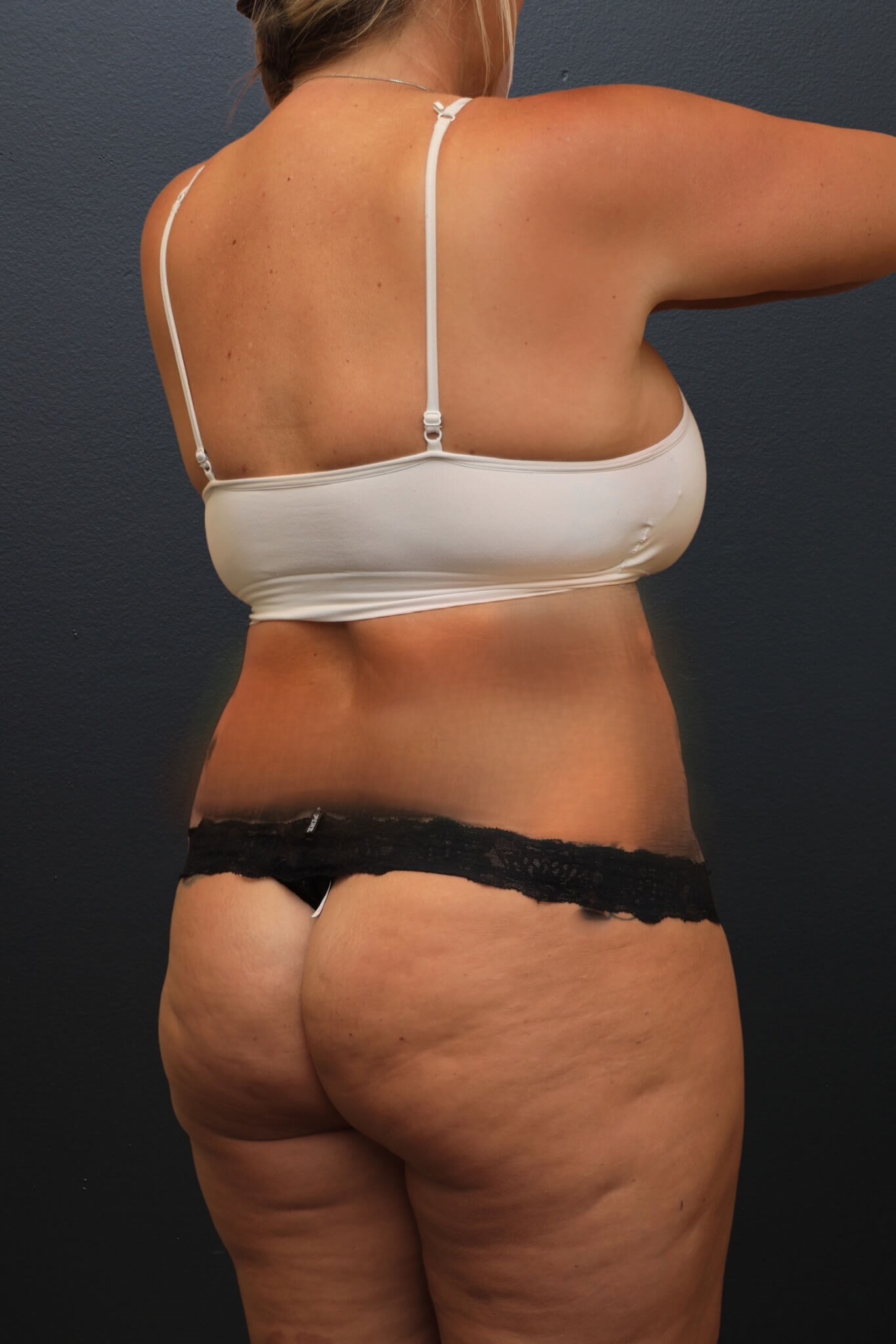 Right Posterior Oblique Before