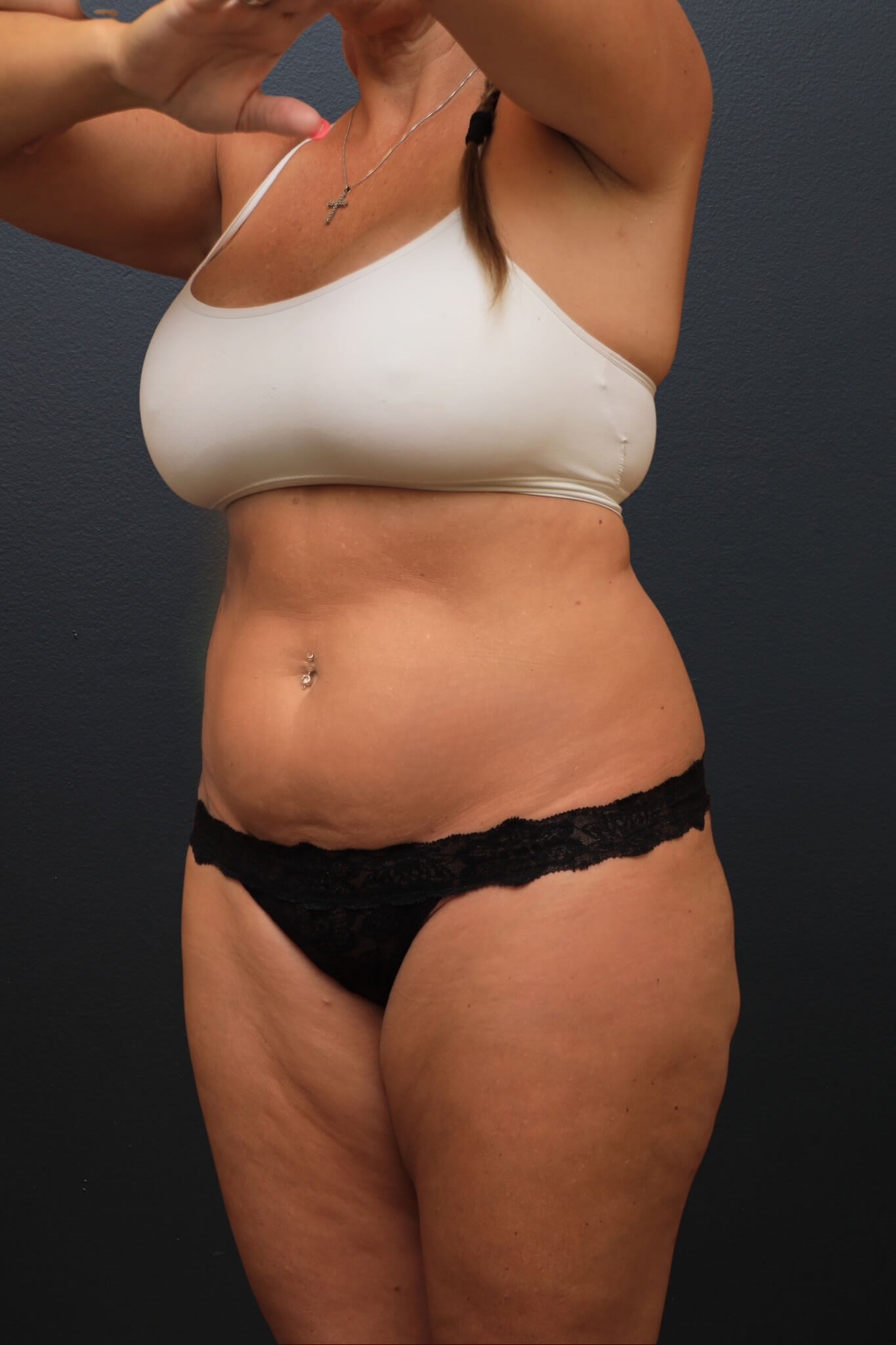 Left Oblique Before