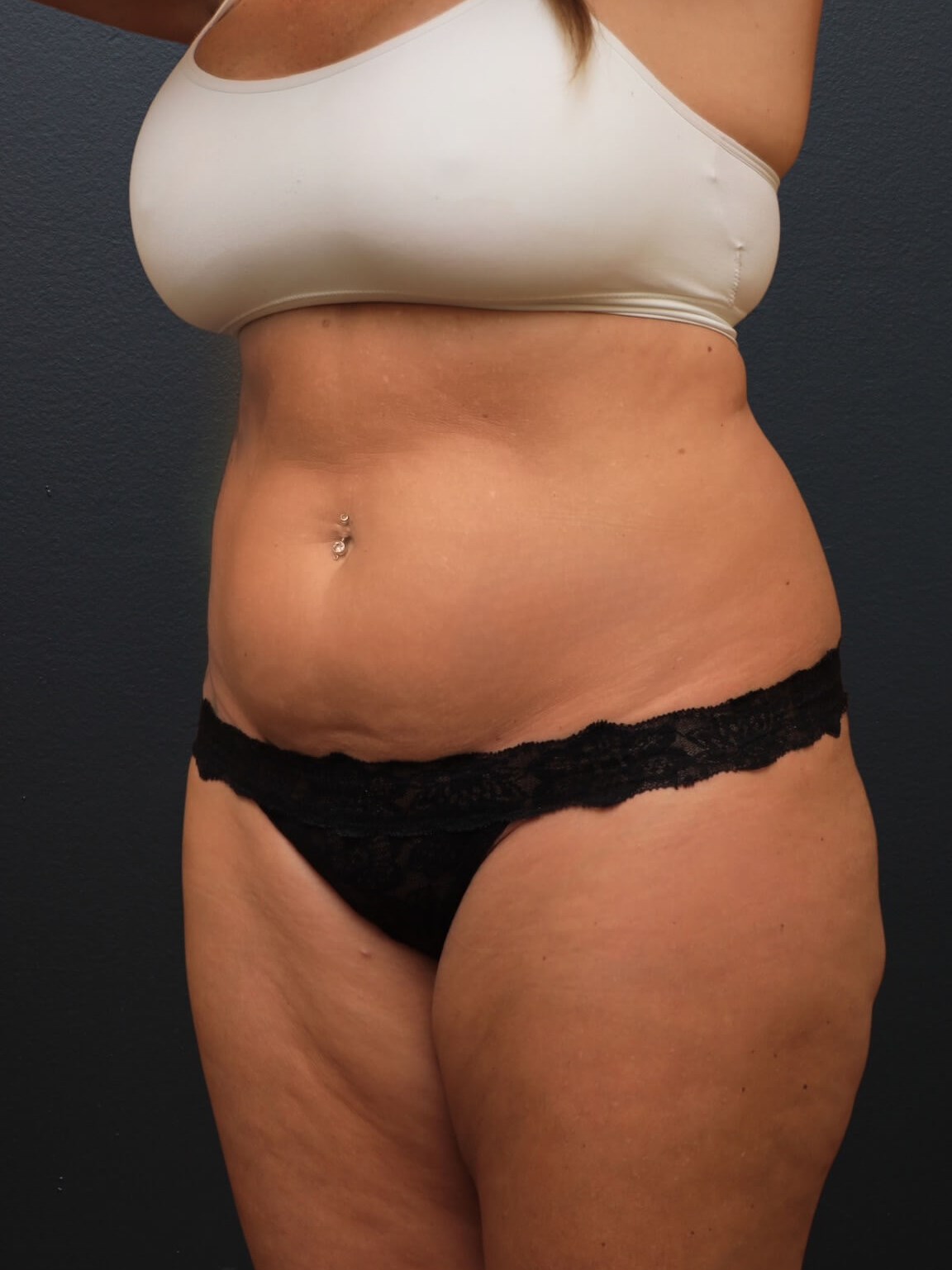 Left Oblique Before