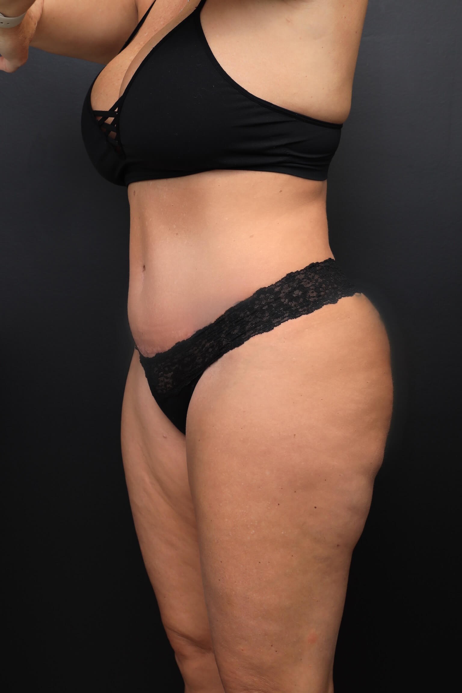 Left Oblique After
