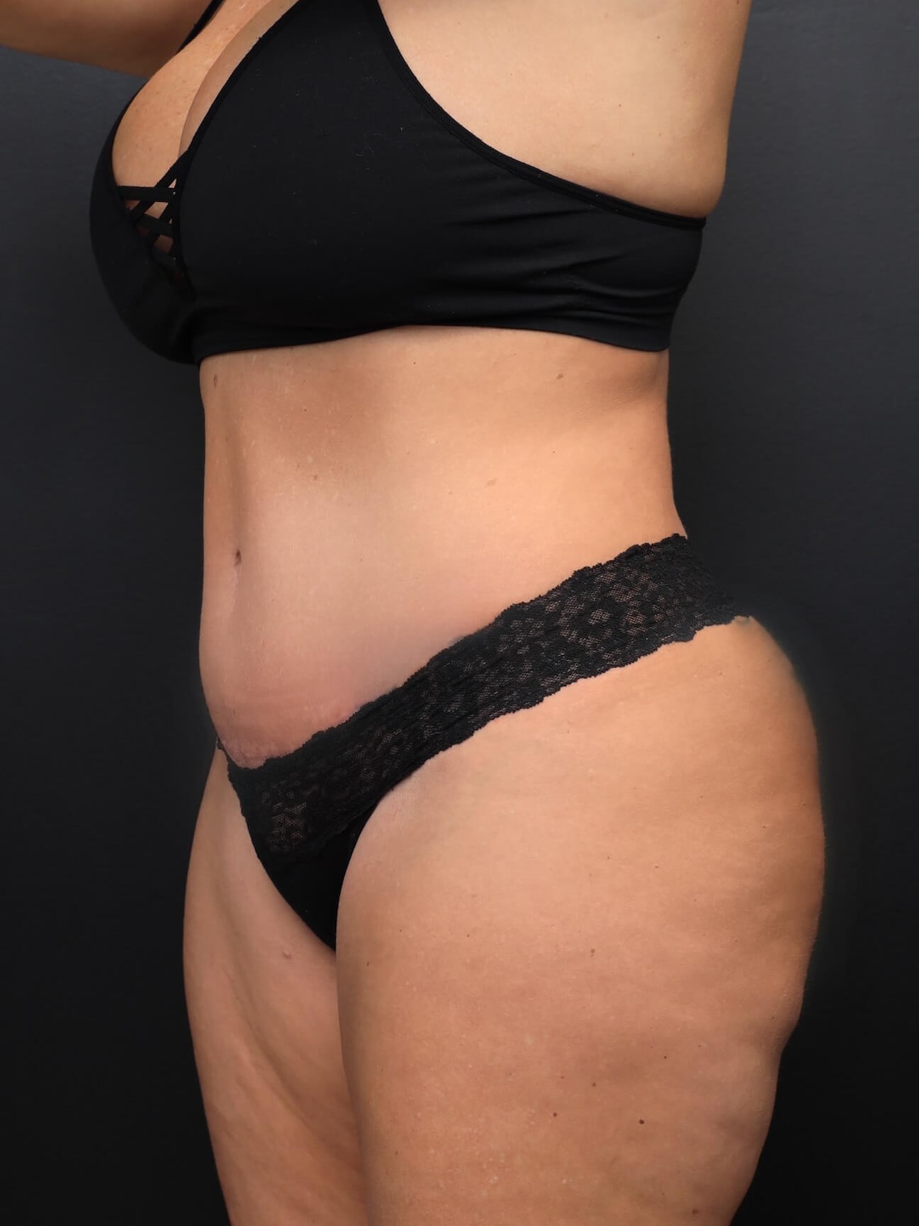 Left Oblique After