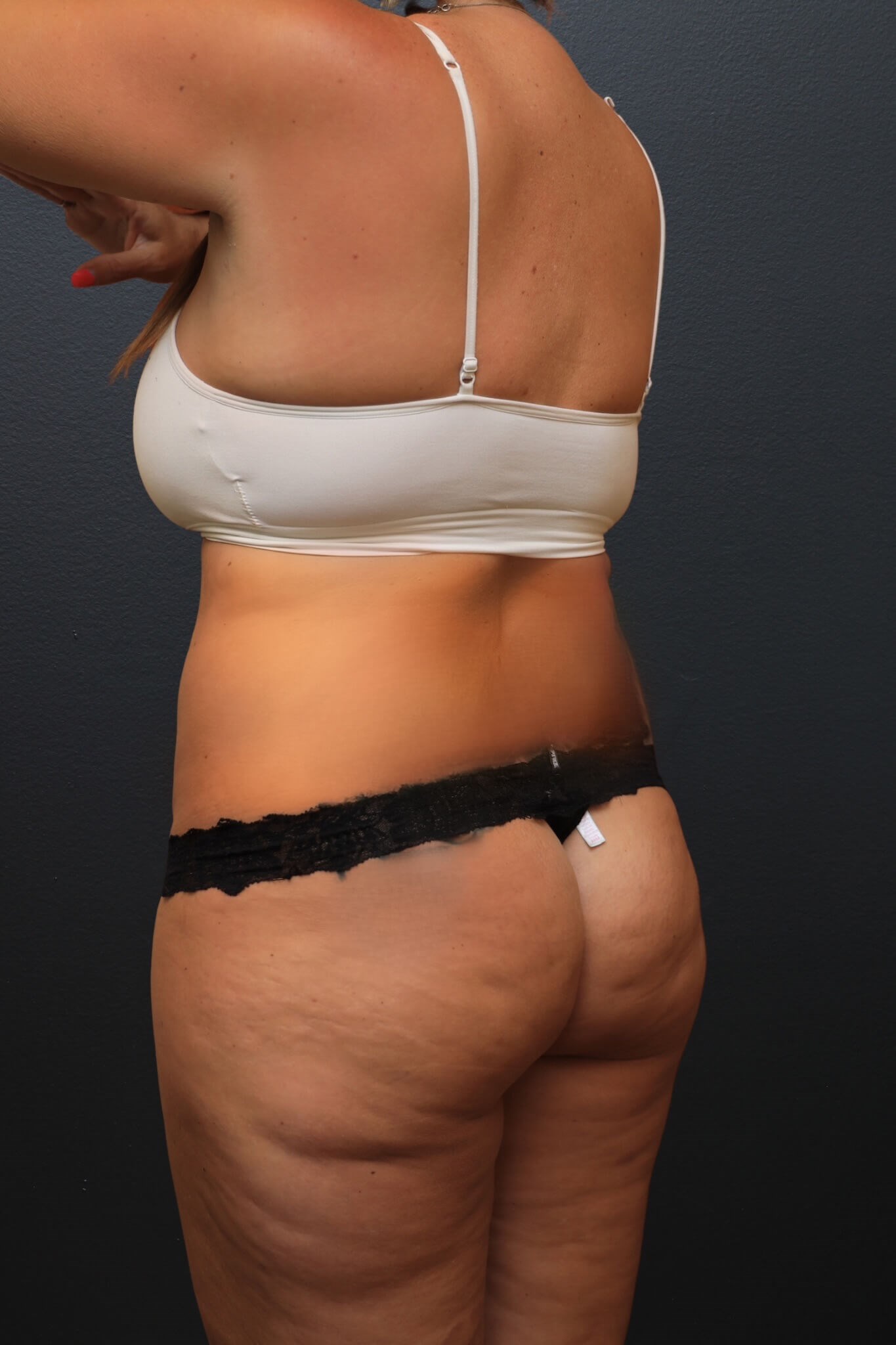 Left Posterior Oblique Before