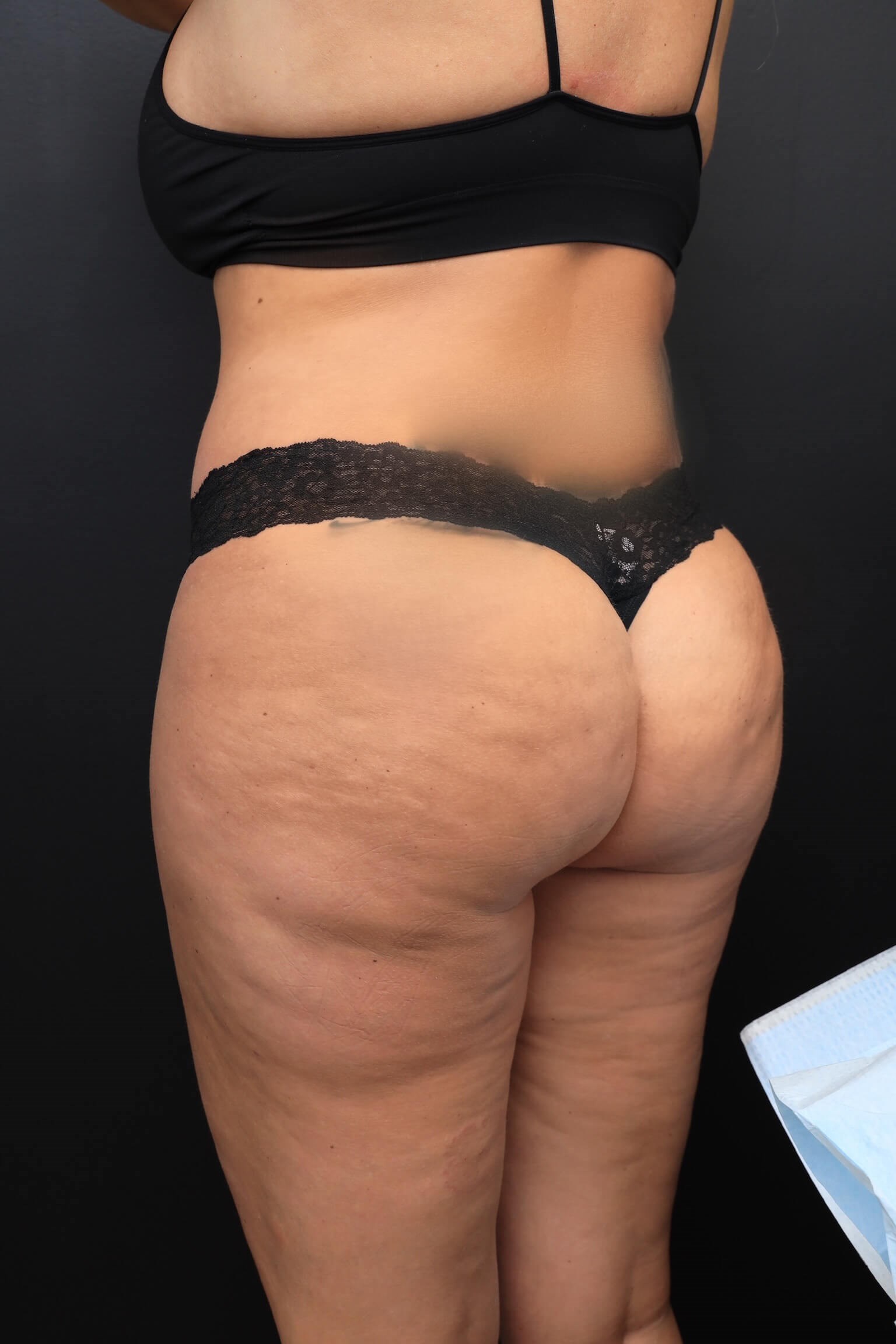 Left Posterior Oblique After