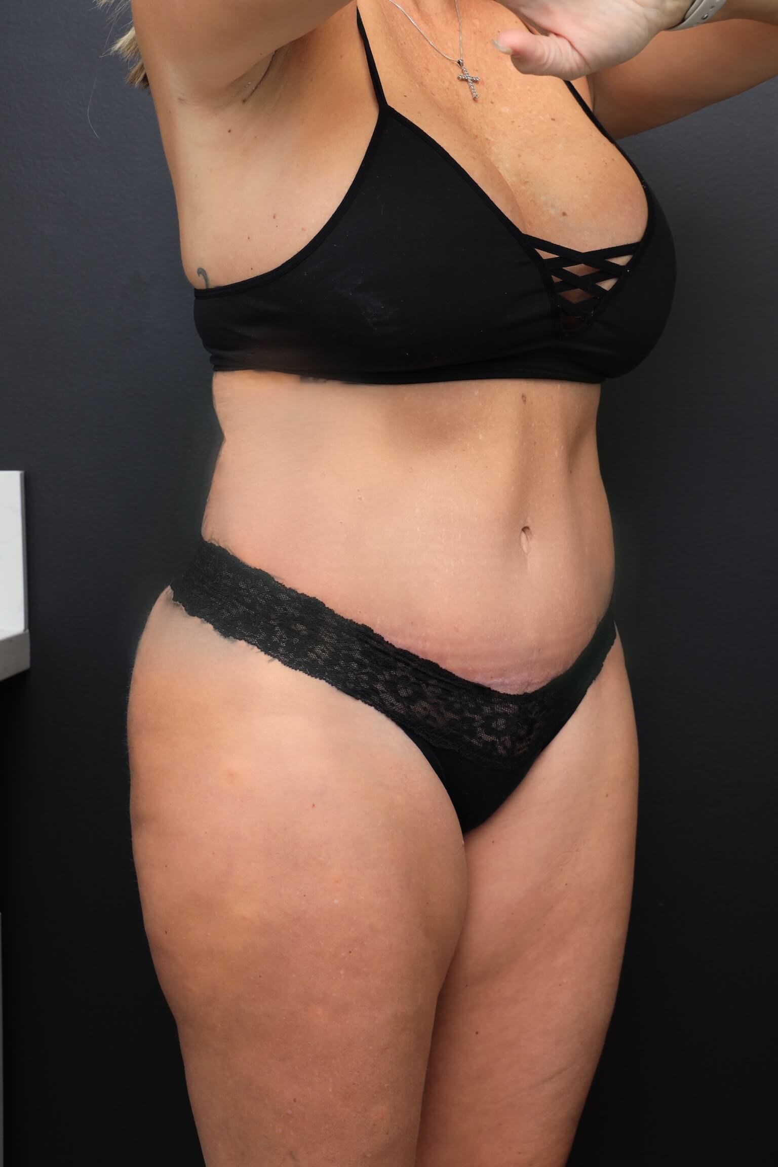 Right Oblique After