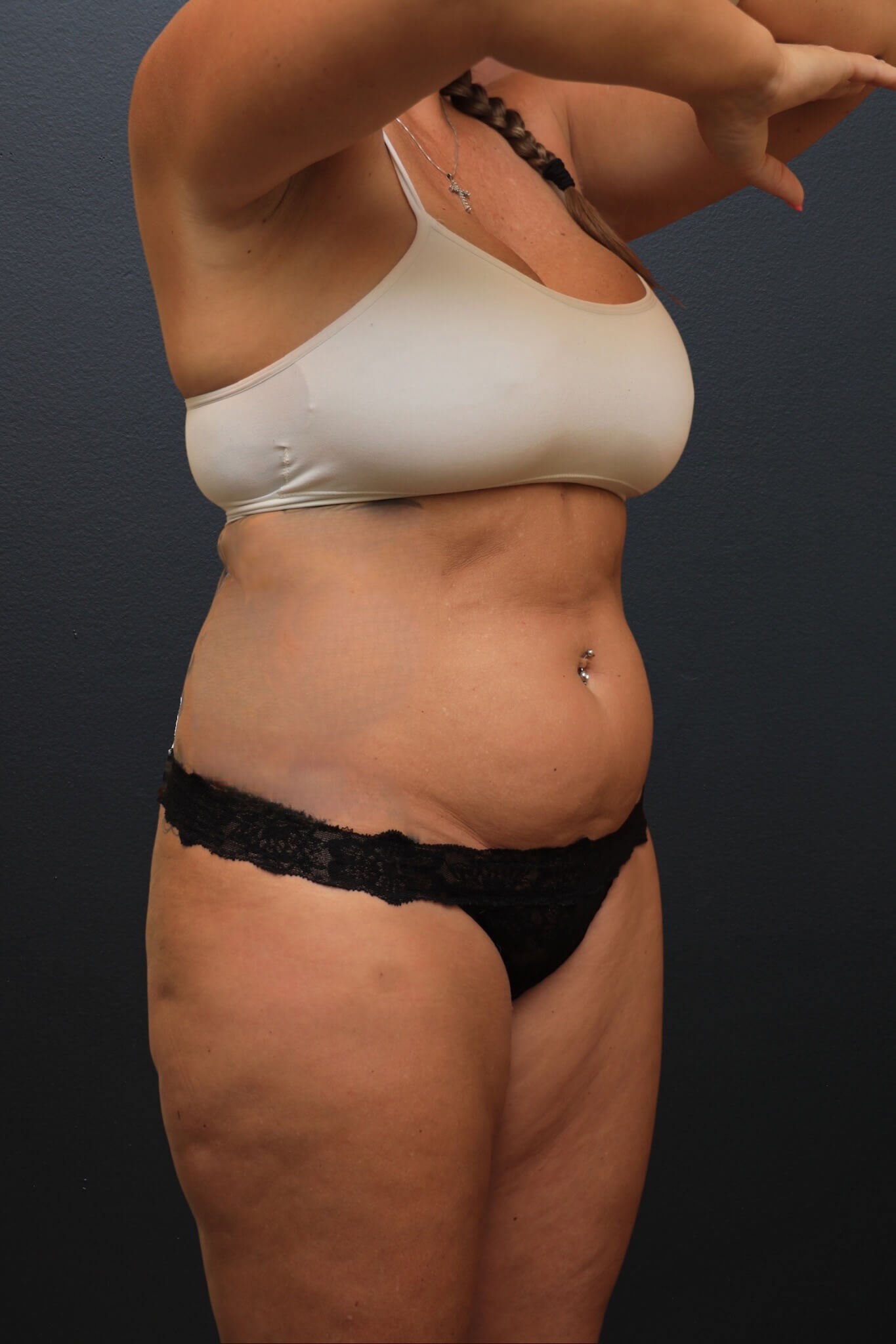 Right Oblique Before
