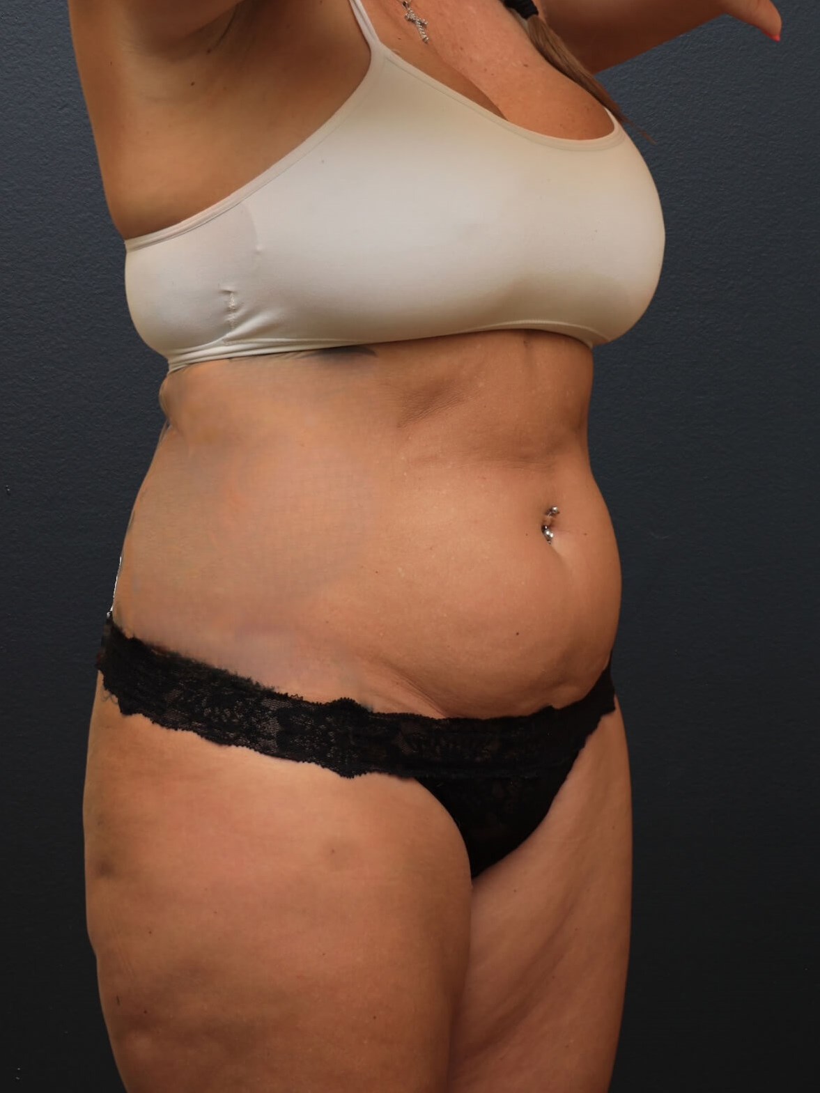Right Oblique Before
