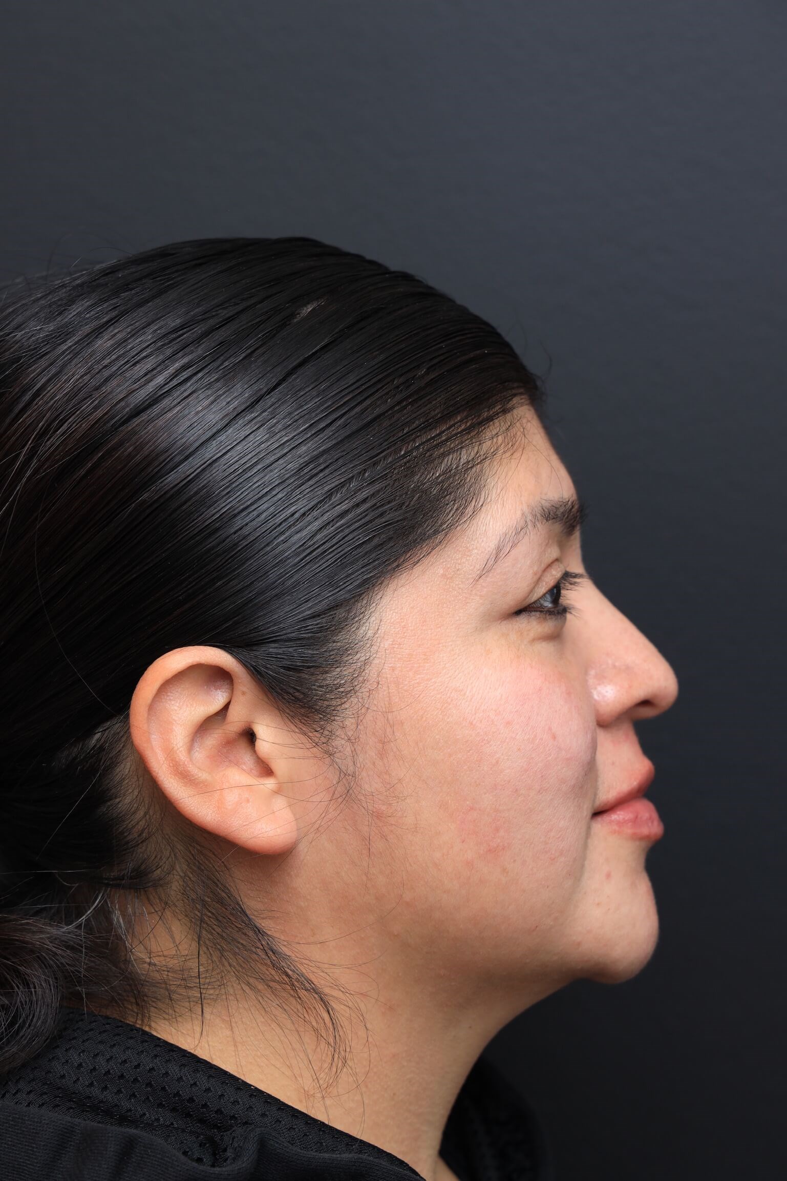 Right Lateral Lips After