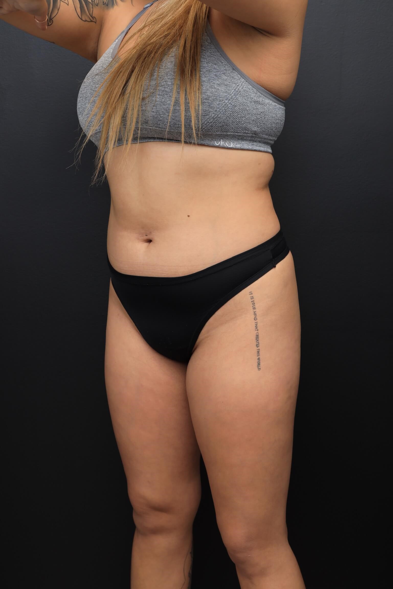 Left Oblique Before