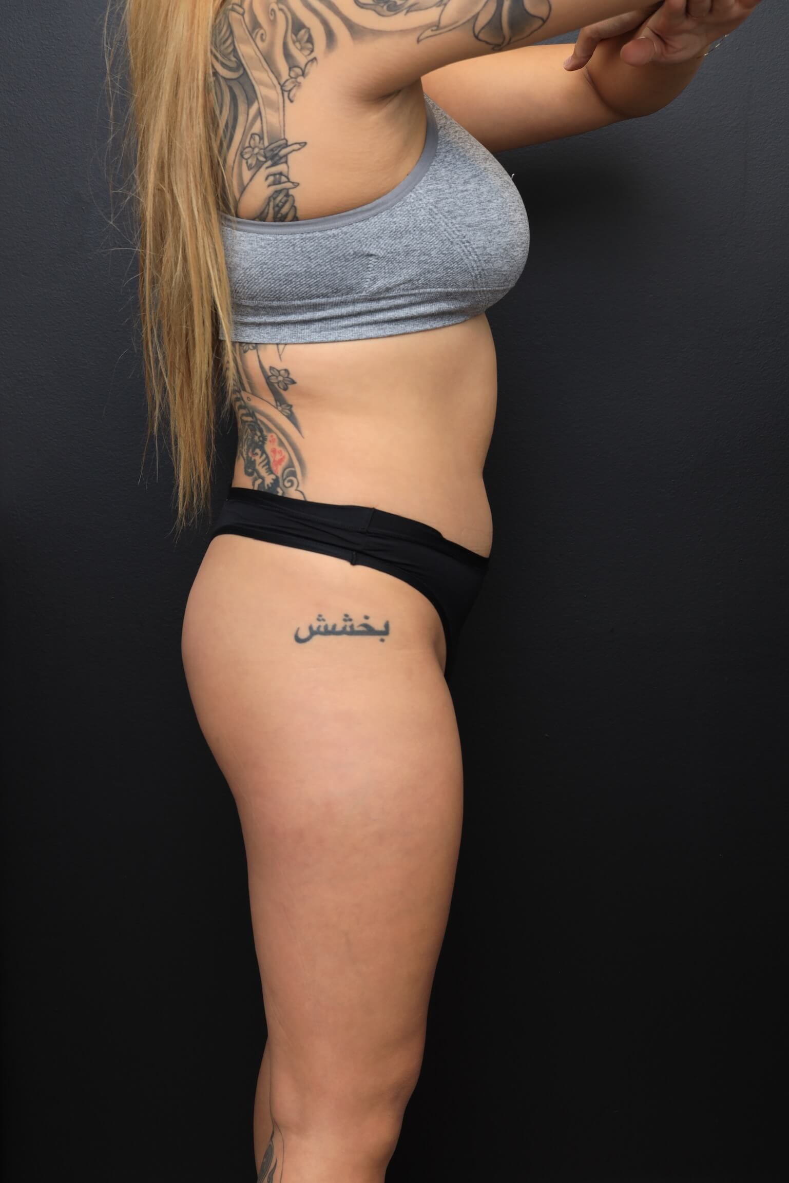 Right Lateral Before