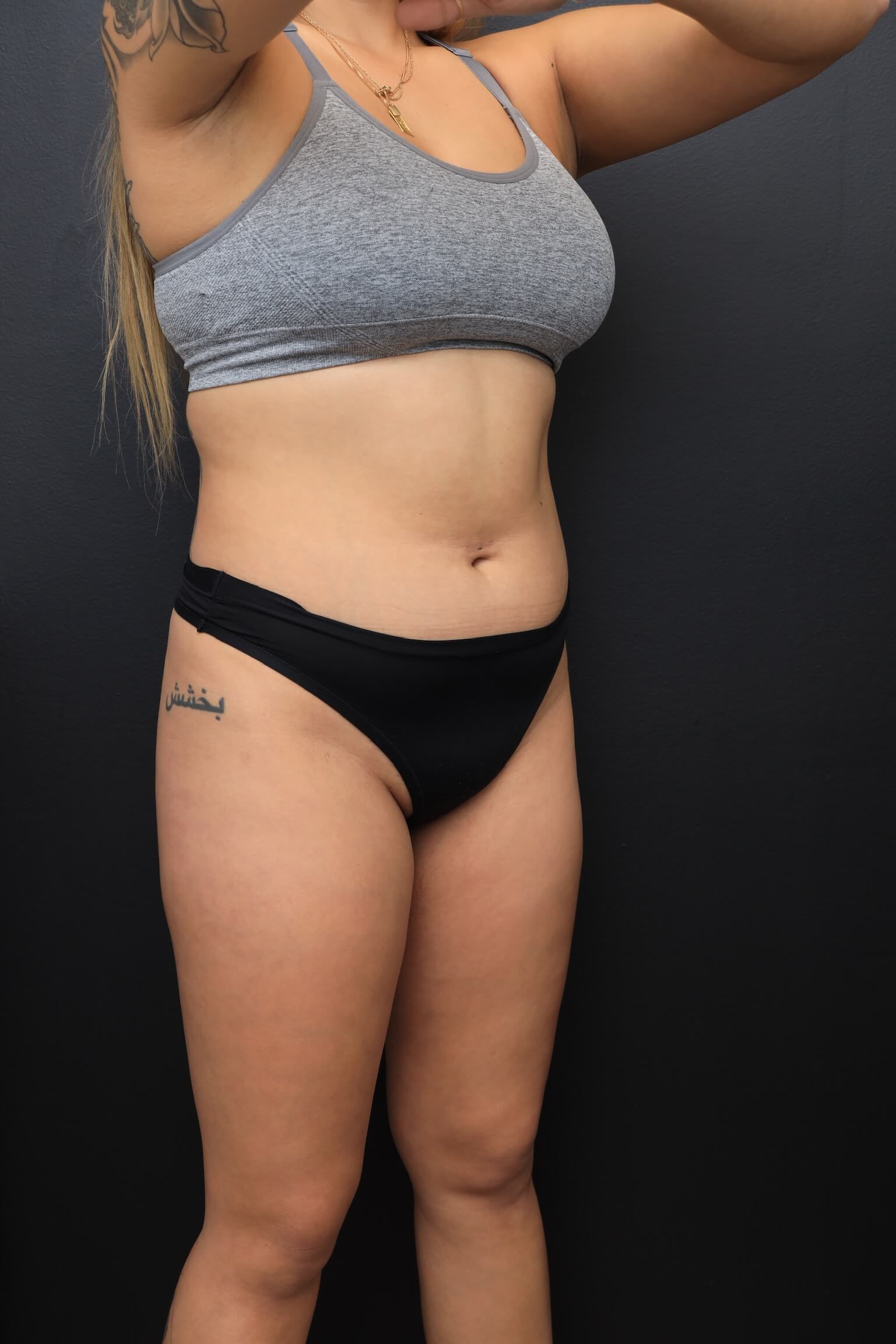 Right Oblique Before