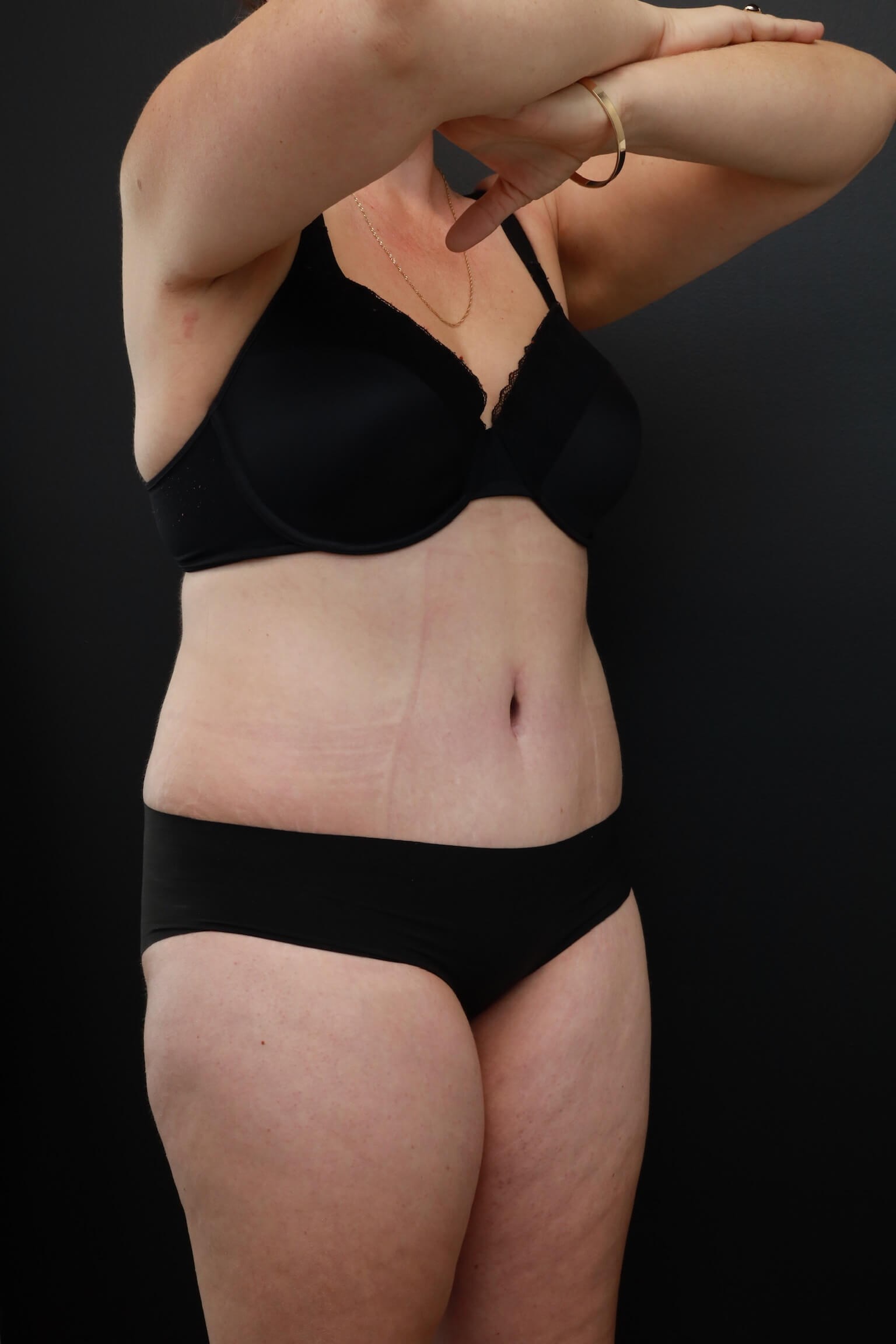 Right Oblique After