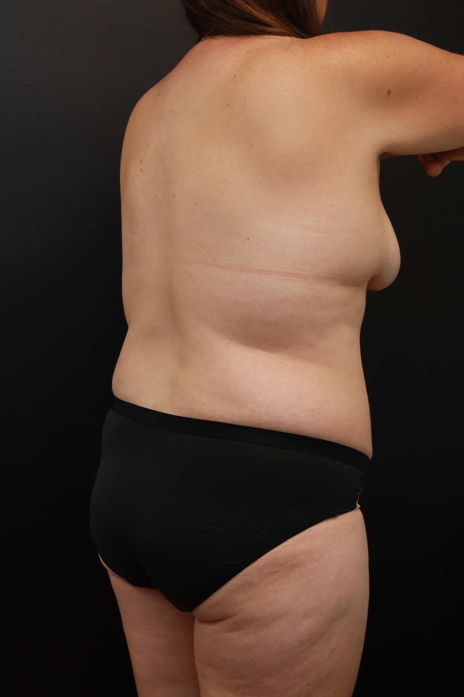 Right Oblique Posterior Before