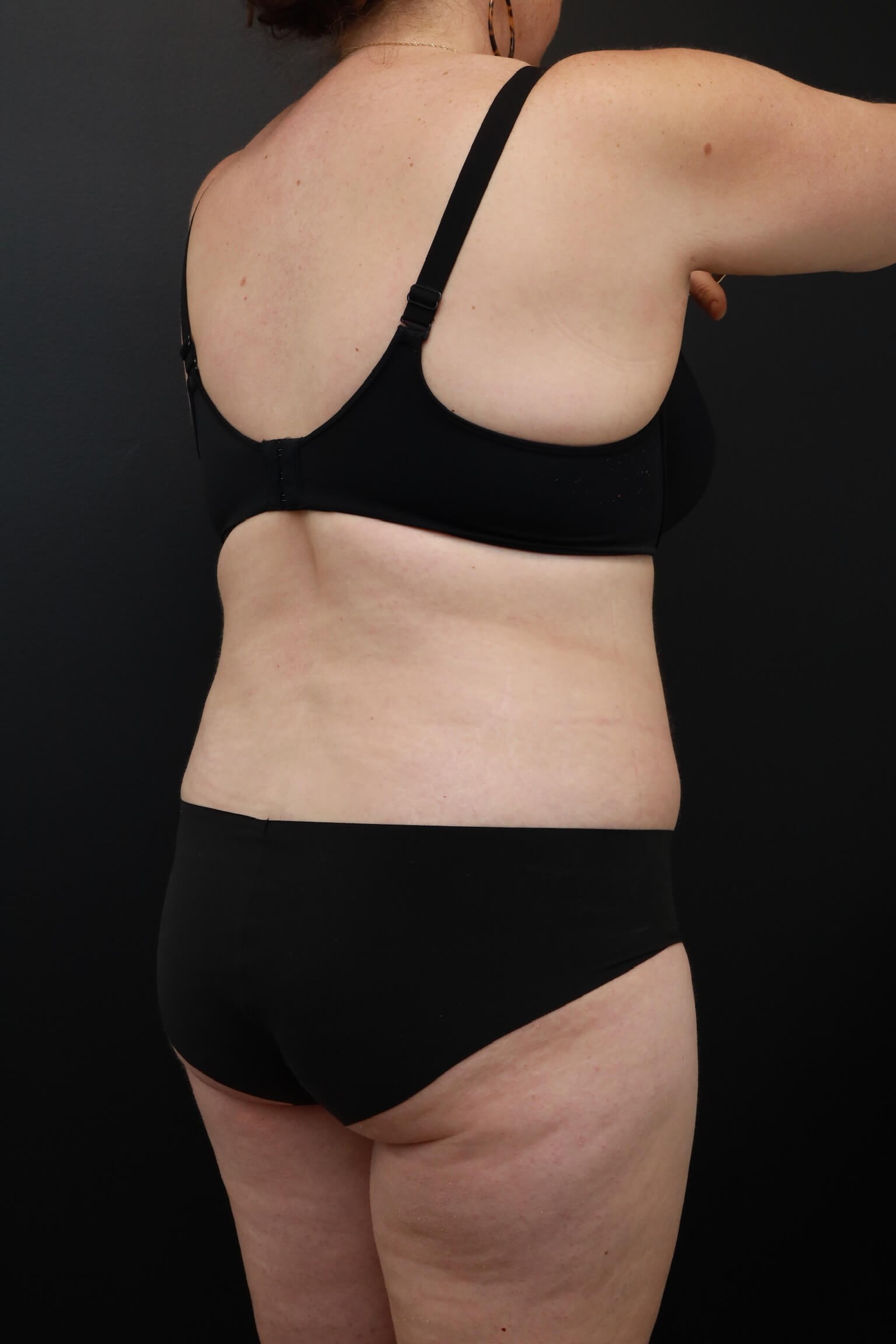 Right Oblique Posterior After