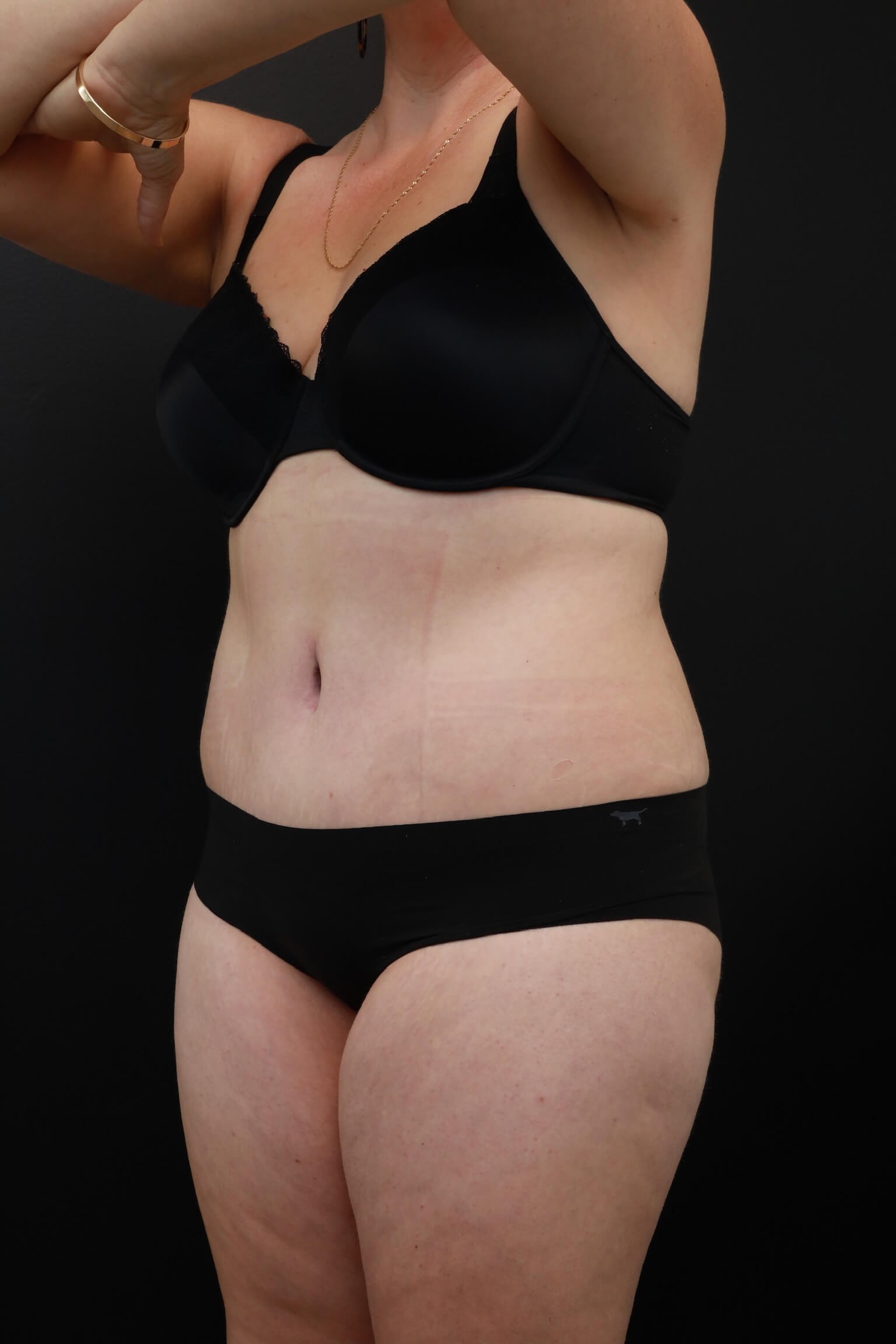 Left Oblique After