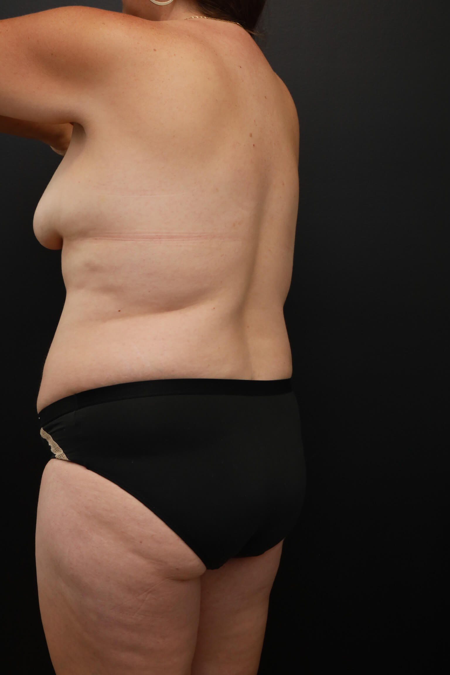 Left Oblique Posterior Before