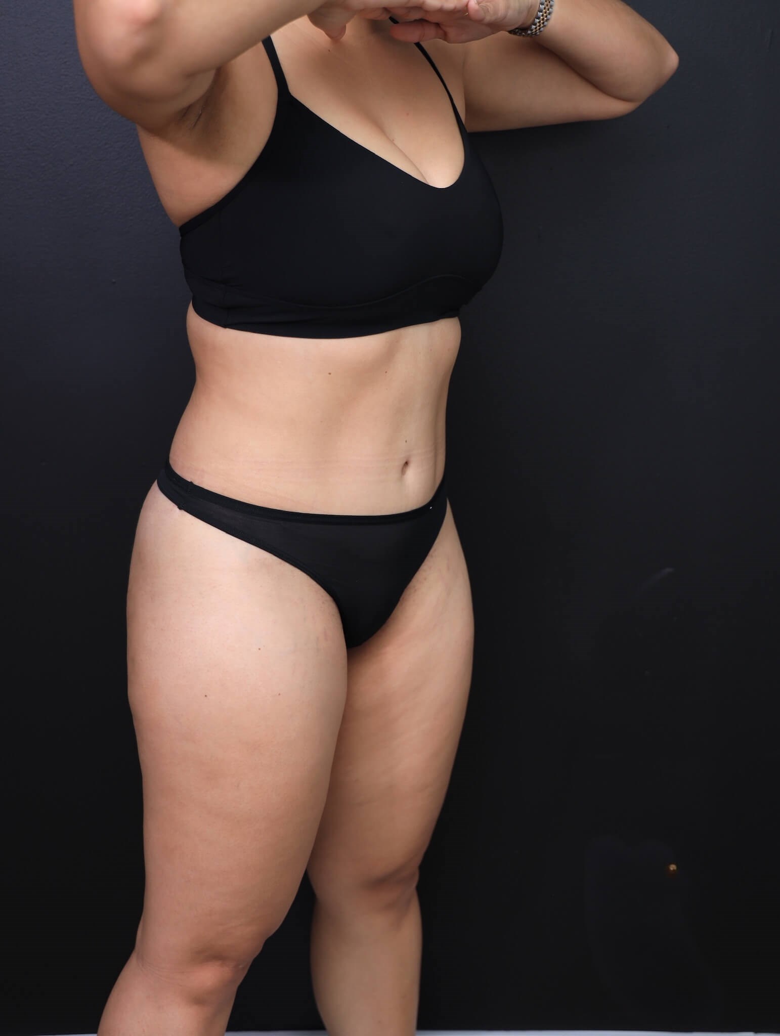 Right Oblique After