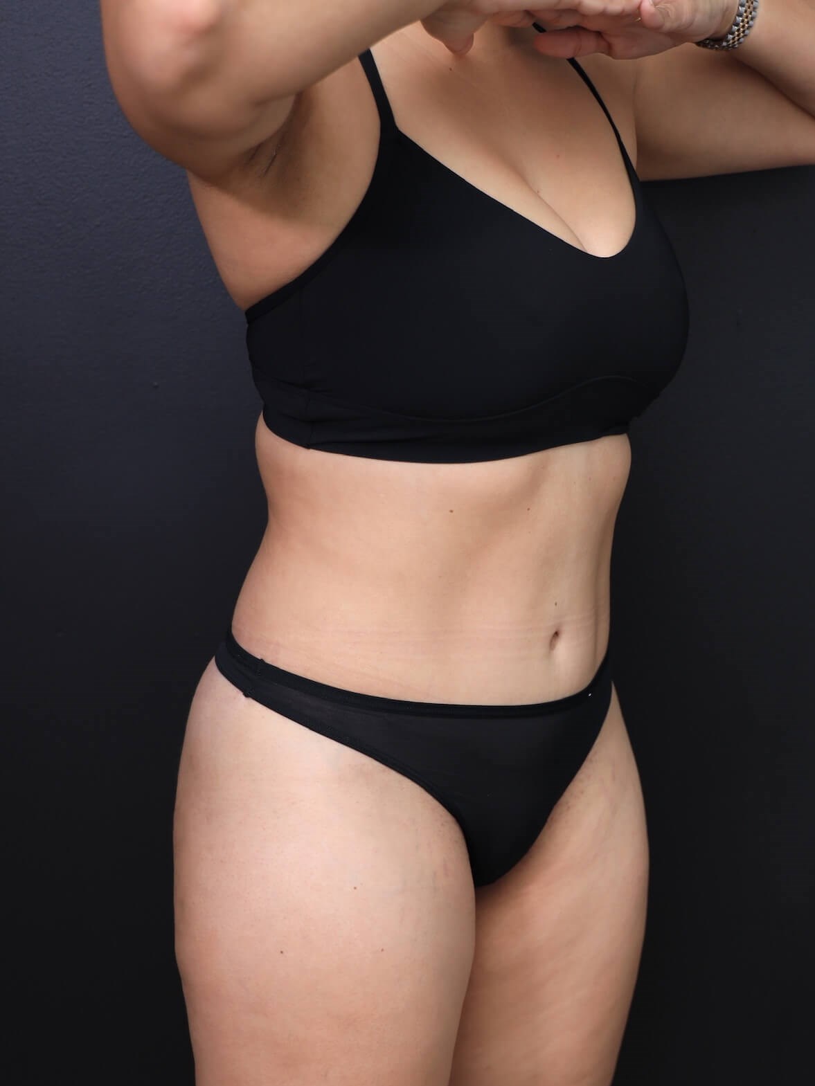 Right Oblique After