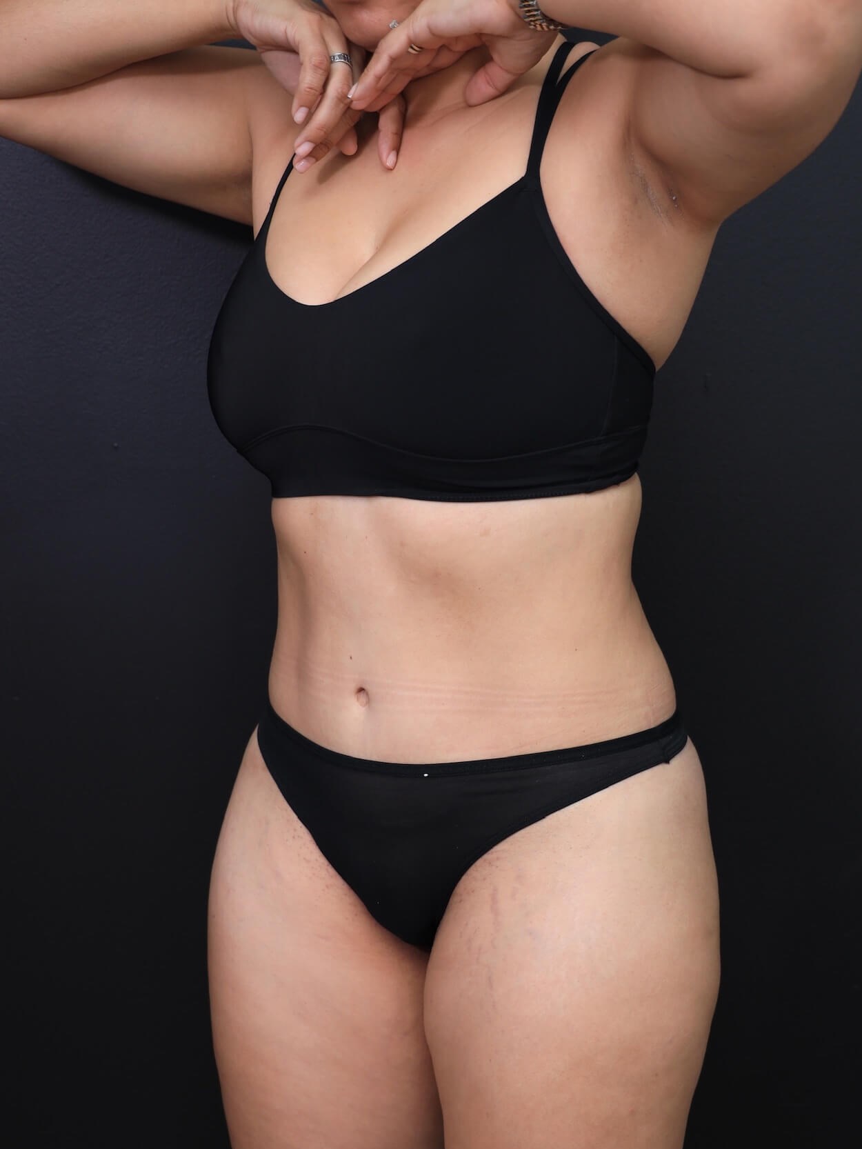 Left Oblique After