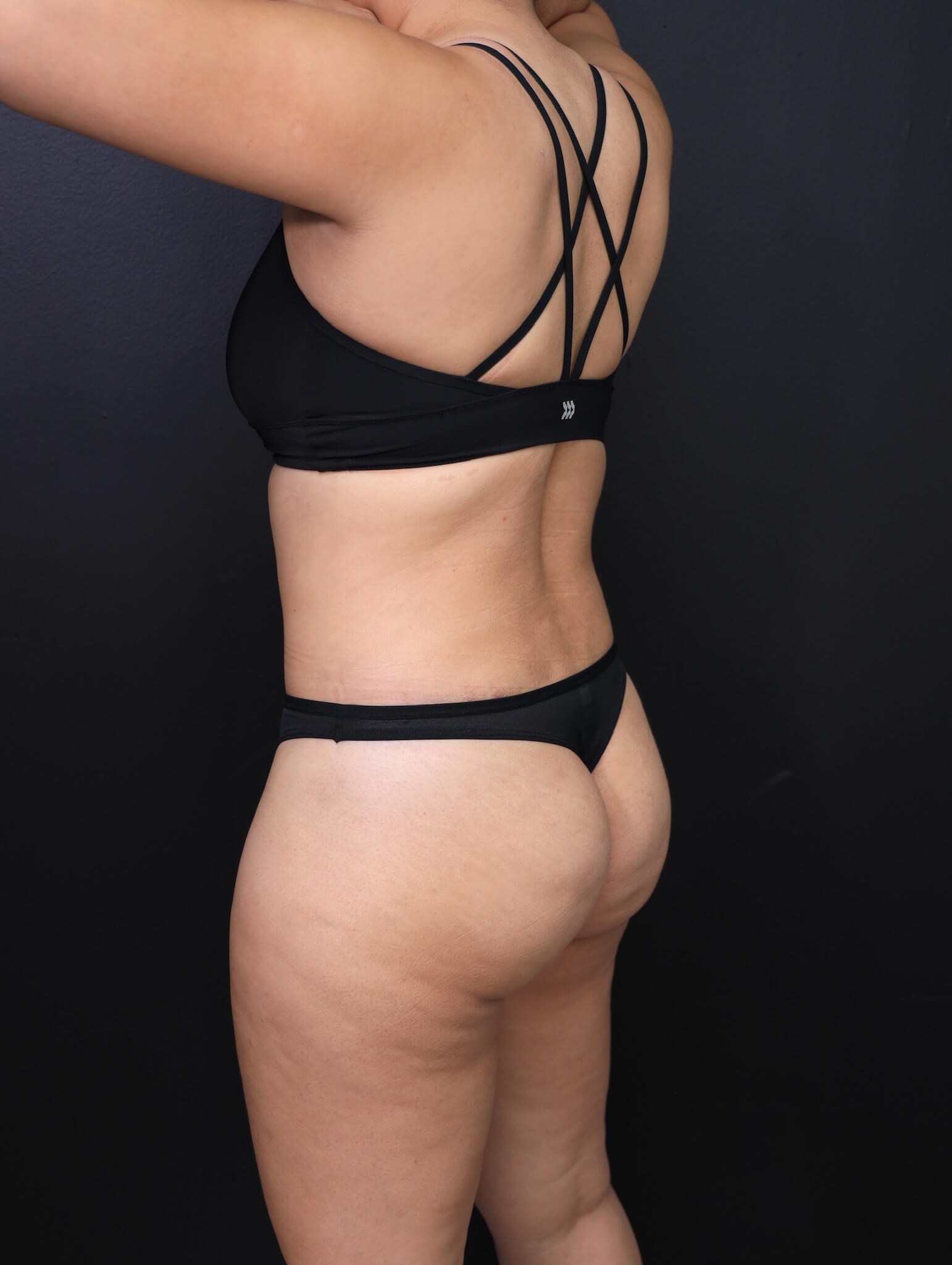 Left Posterior Oblique After
