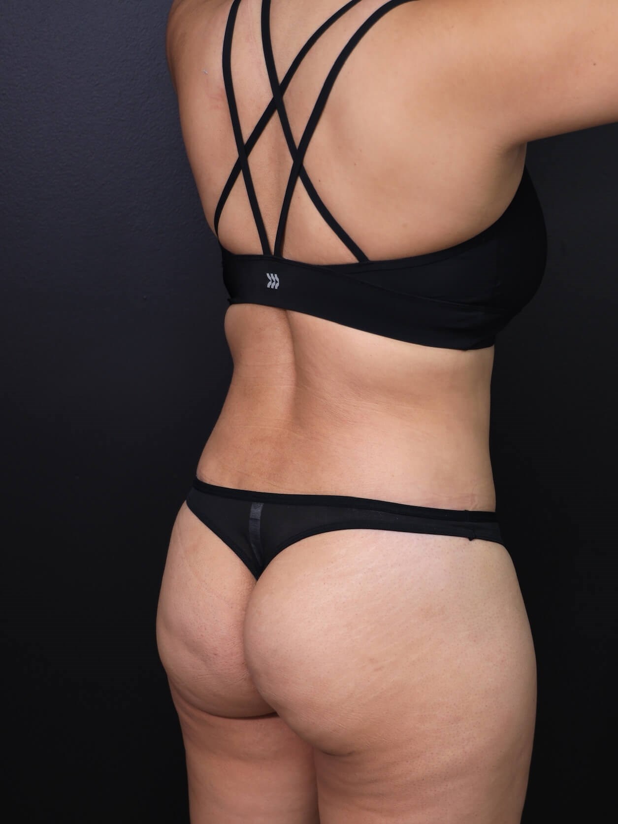 Right Posterior Oblique After