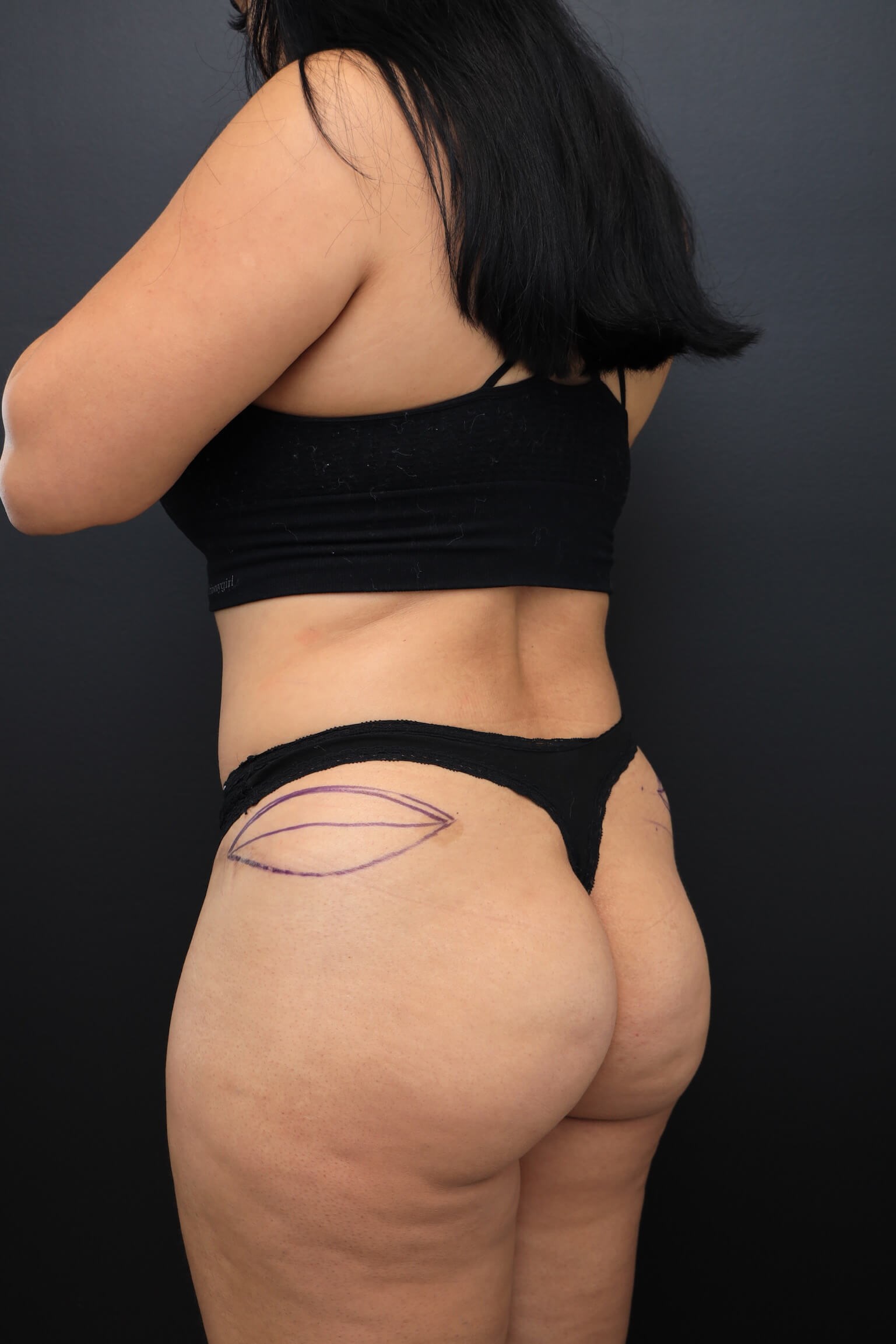 Left Posterior Oblique Before
