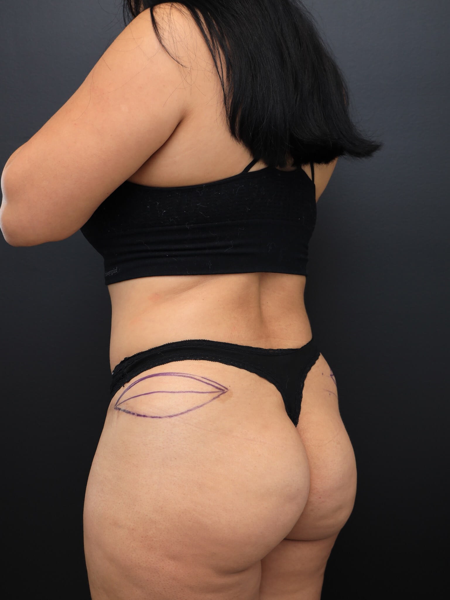 Left Posterior Oblique Before