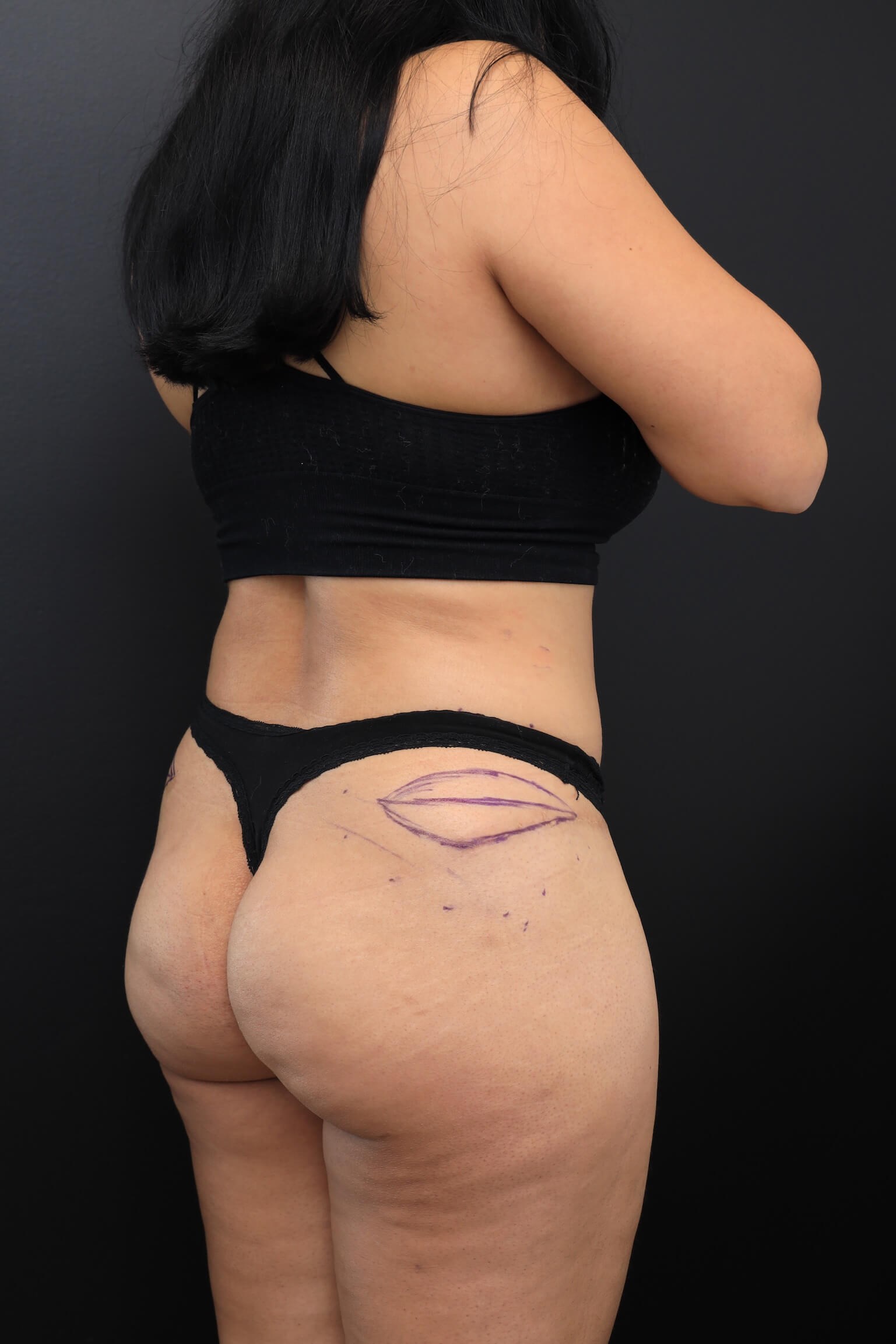 Right Posterior Oblique Before