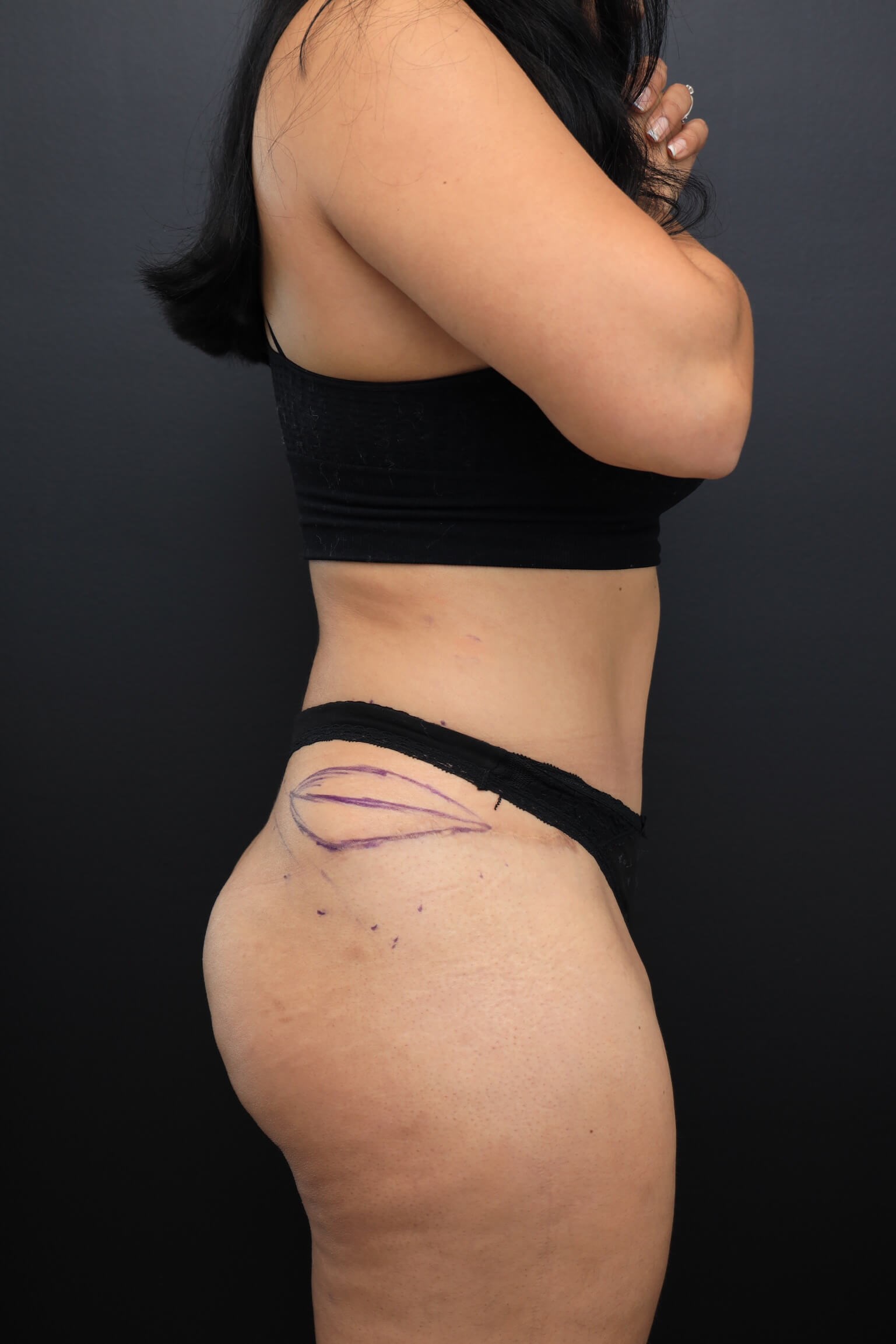 Right Lateral Before
