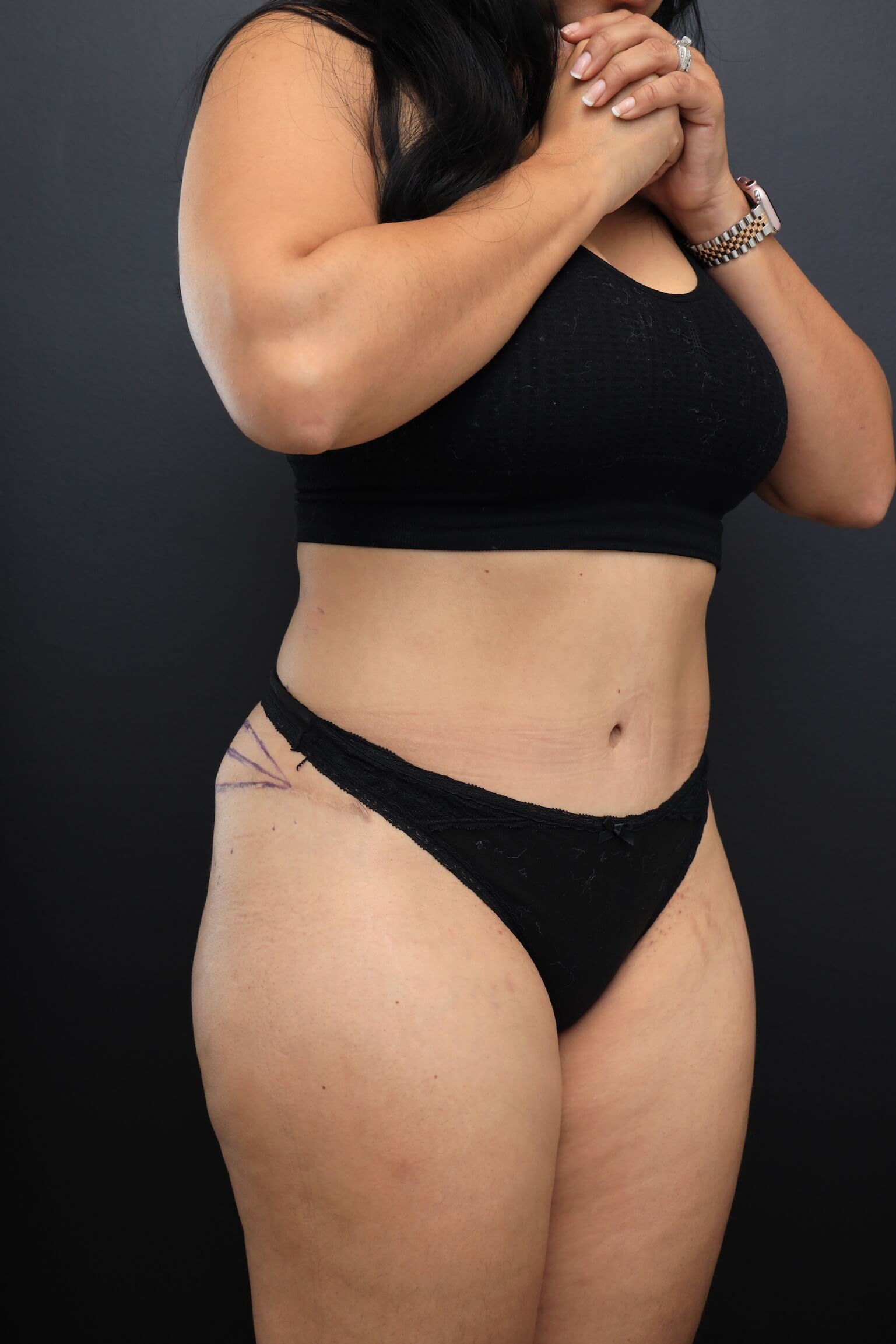 Right Oblique Before