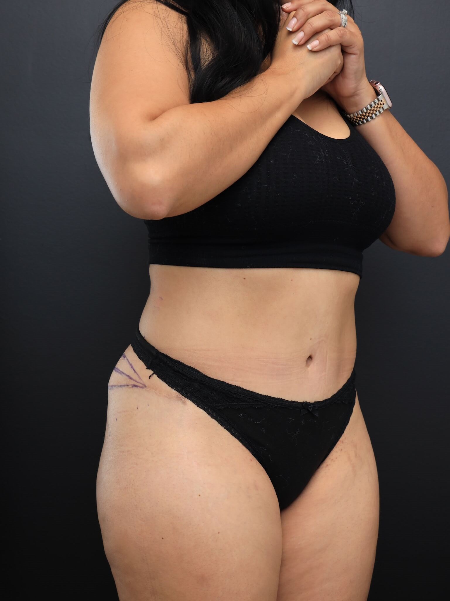 Right Oblique Before