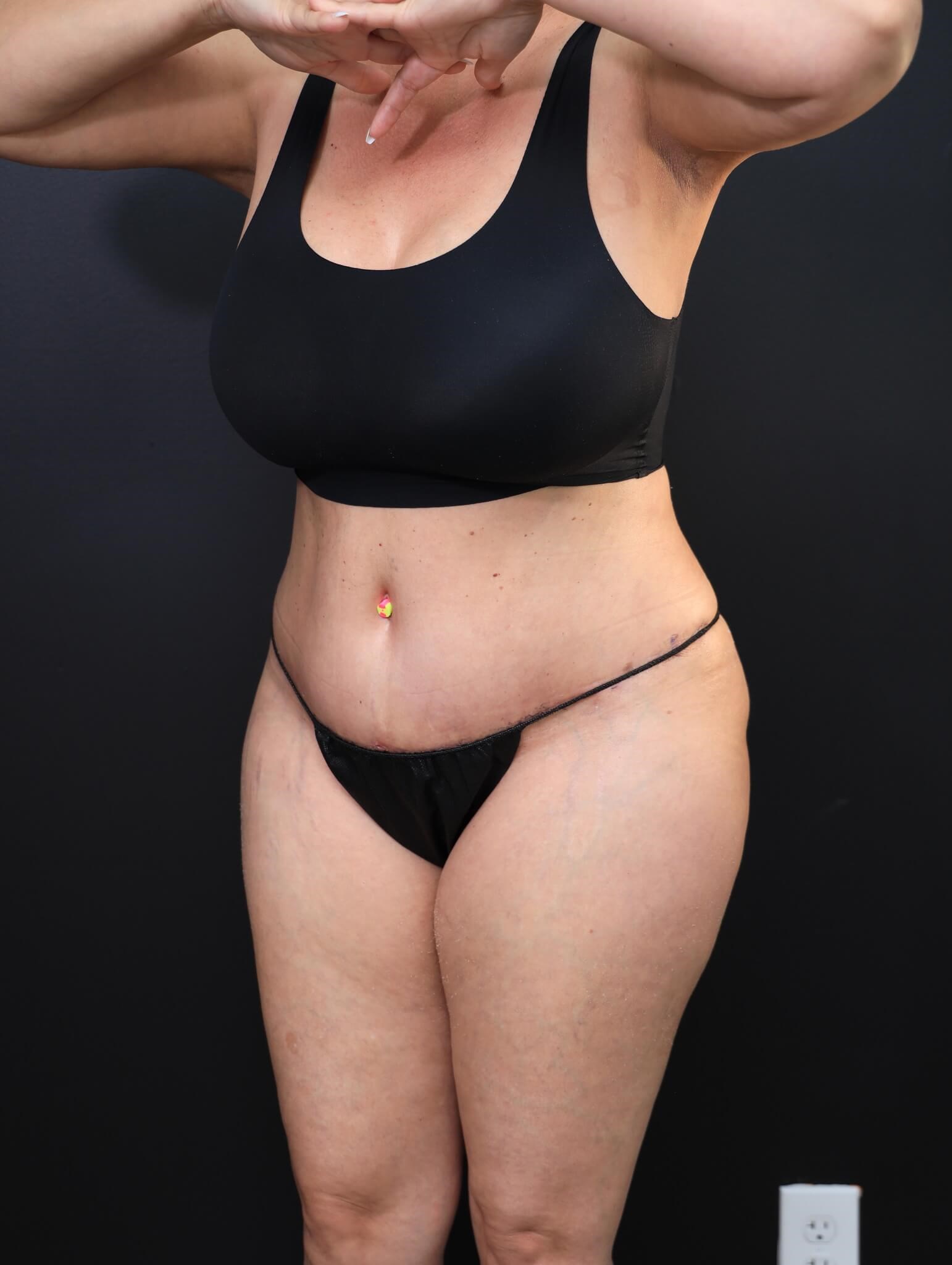 Left Oblique After