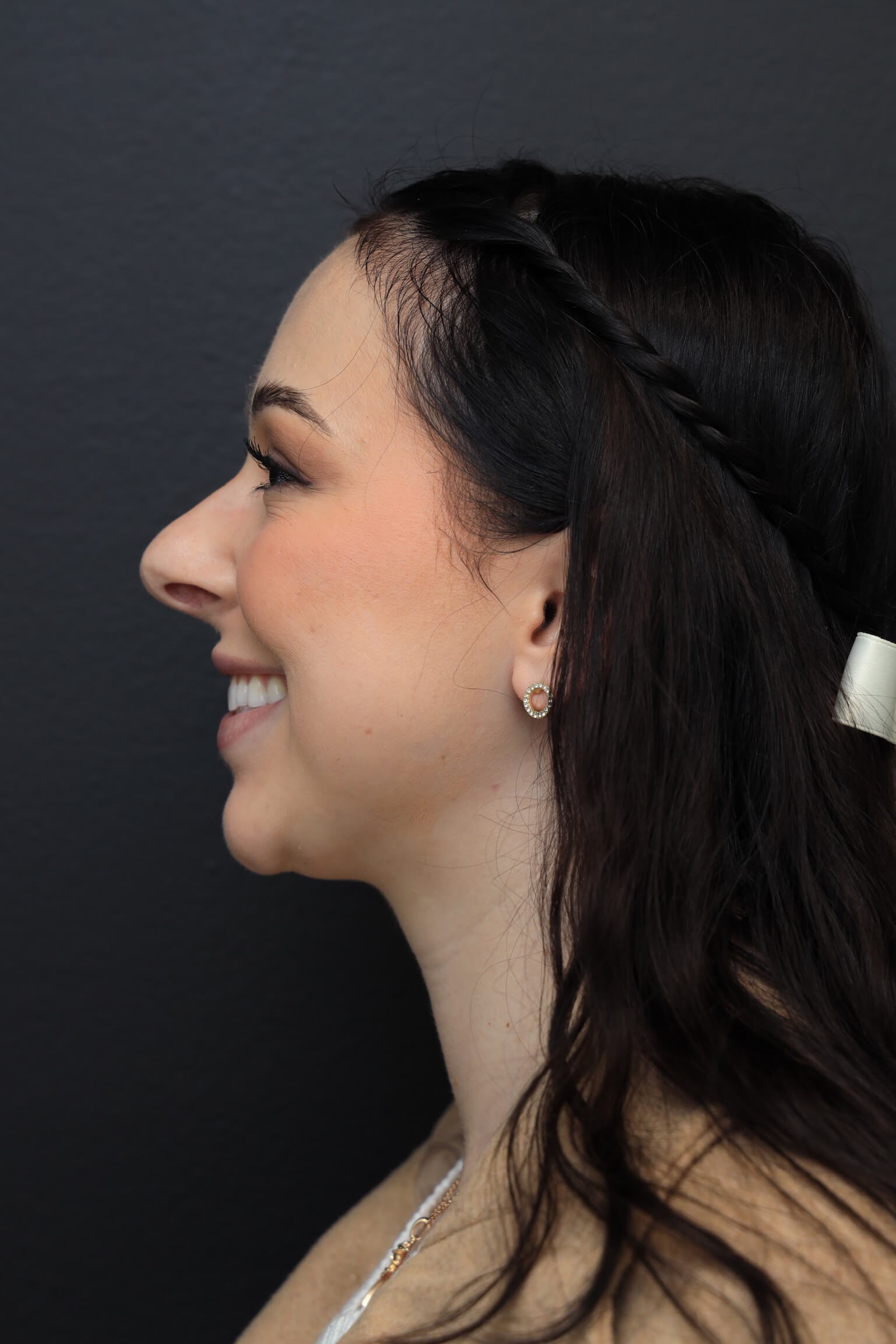 Left Lateral - Smiling Before