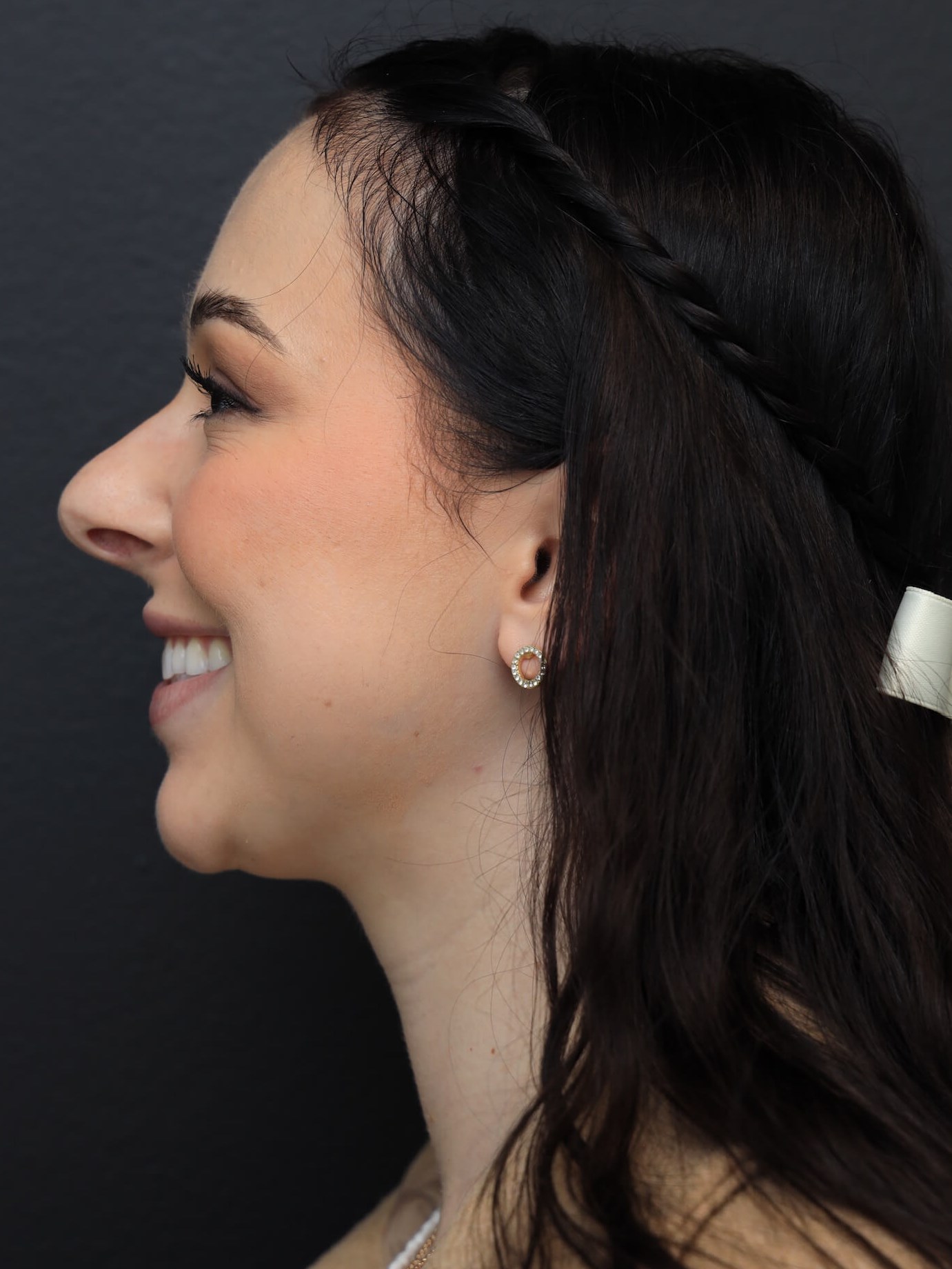 Left Lateral - Smiling Before
