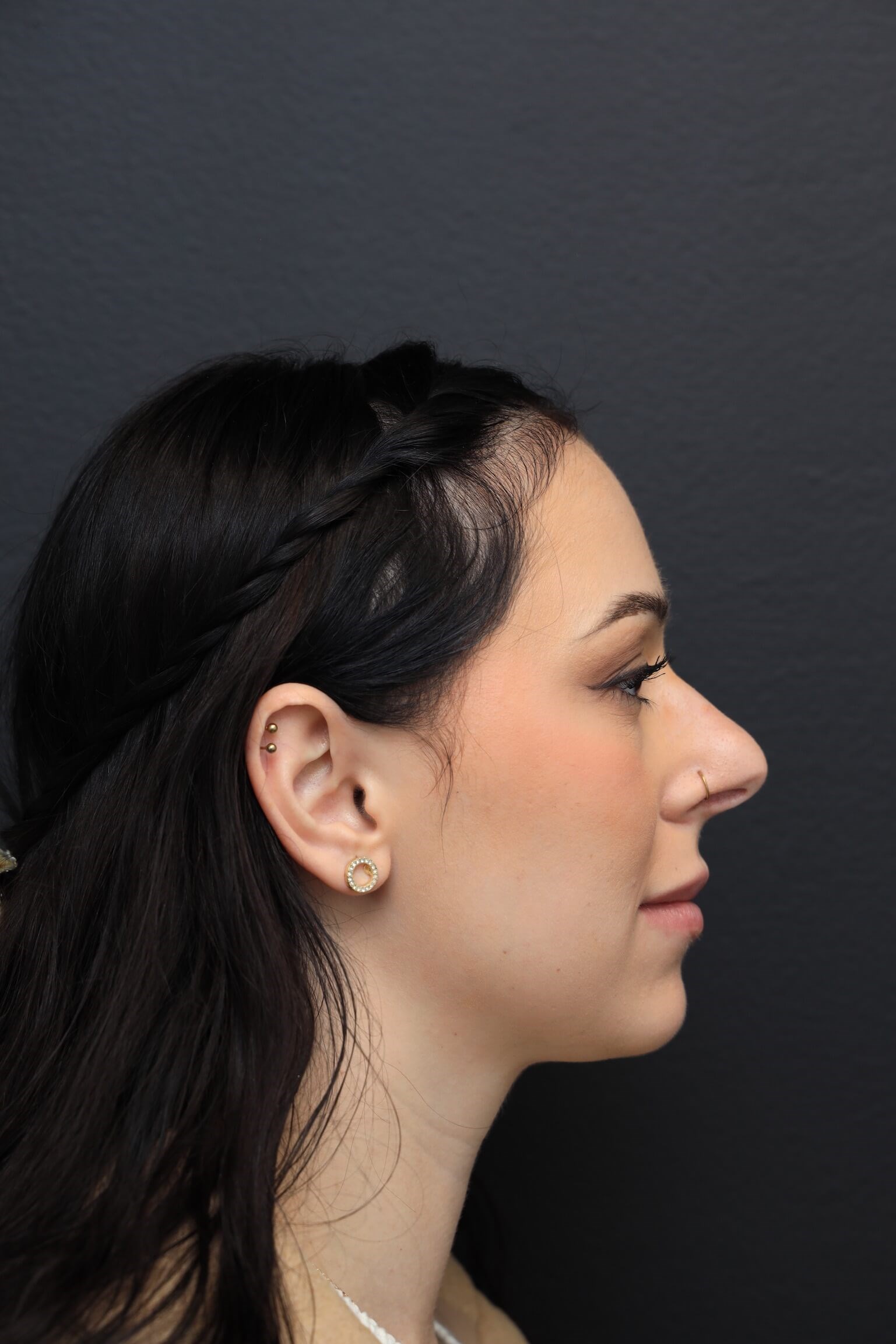 Right Lateral Before