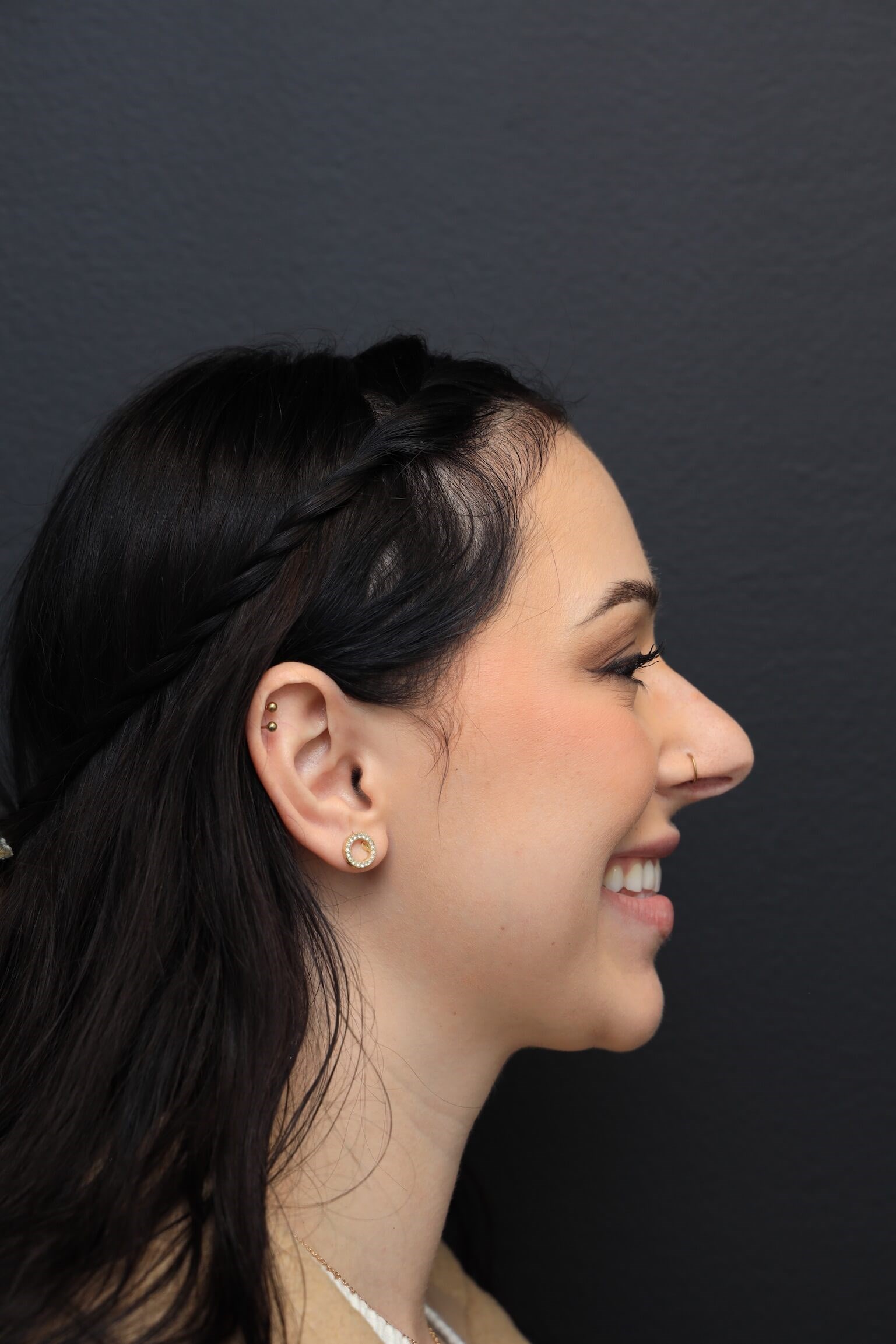 Right Lateral - Smiling Before