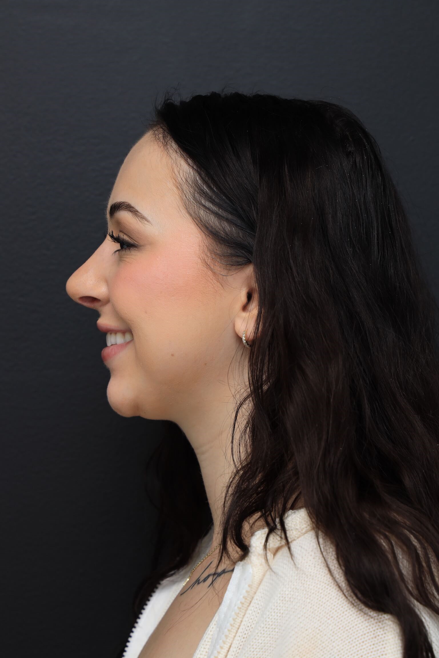 Left Lateral - Smiling After
