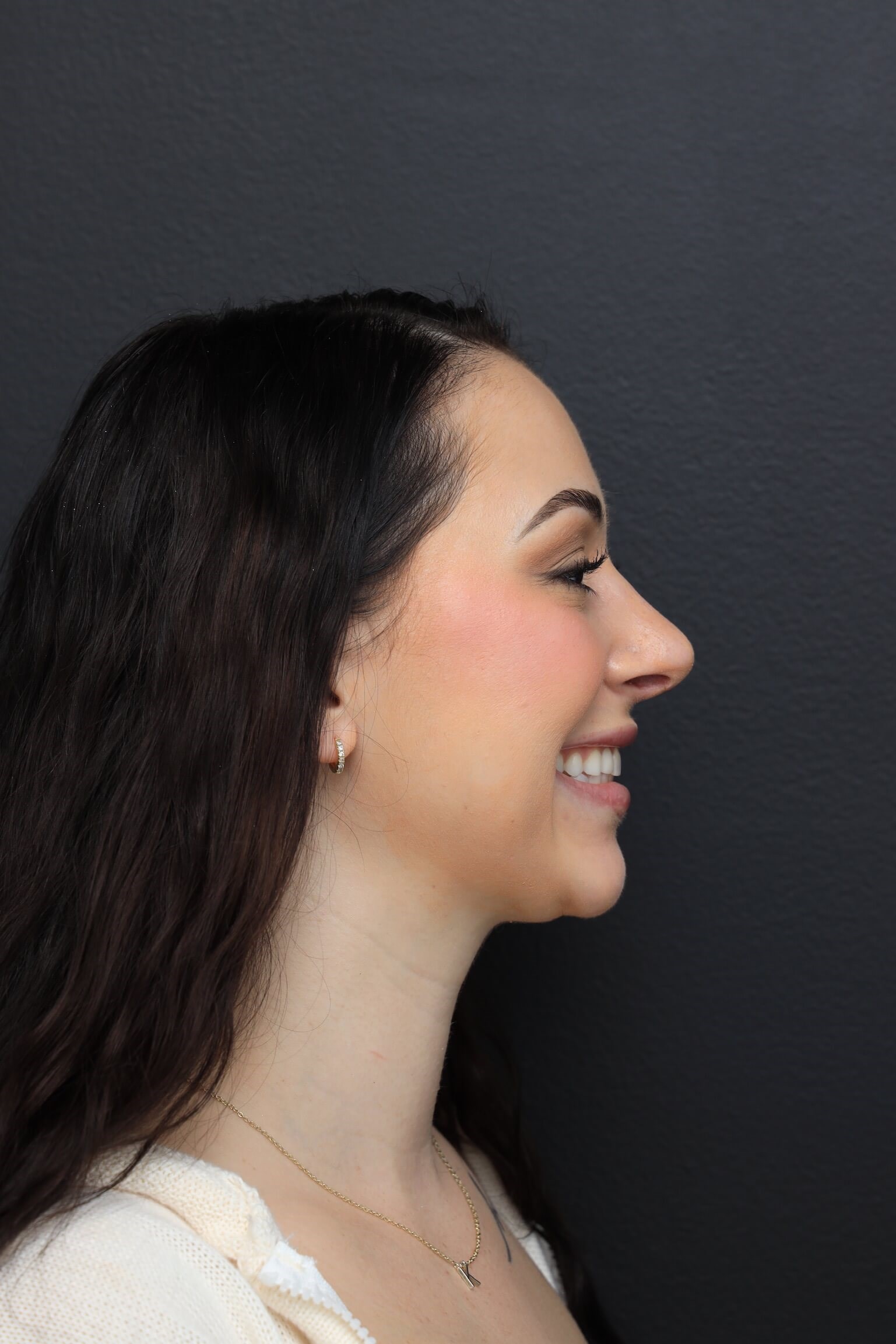 Right Lateral - Smiling After